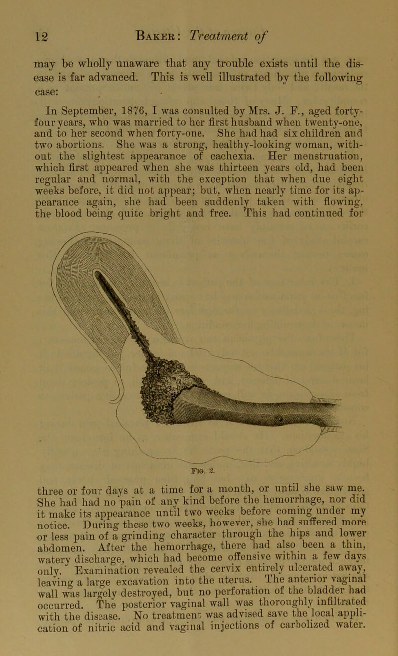 may be wholly unaware that any trouble exists until the dis- ease is far advanced. This is well illustrated by the following case: In September, 1876, I was consulted by Mrs. J. F., aged forty- four years, who was married to her first husband when twenty-one, and to her second when forty-one. She had had six children and two abortions. She was a strong, healthy-looking woman, with- out the slightest appearance of cachexia. Her menstruation, which first appeared when she was thirteen years old, had been regular and normal, with the exception that when due eight weeks before, it did not appear; but, when nearly time for its ap- pearance again, she had been suddenly taken with fiowing, the blood being quite bright and free. This had continued for Fig. 2. three or four days at a time for a month, or until she saw me. She had had no pain of any kind before the hemorrhage, nor did it make its appearance until two weeks before coming under my notice. During these two weeks, however, she had suffered more or less pain of a grinding character through the hips and lower abdomen. After the hemorrhage, there had also been a thin, watery discharge, which had become offensive within a few days only. Examination revealed the cervix entirely ulcerated away, leaving a large excavation into the uterus. The anterior vaginal wall was largely destroyed, but no perforation of the bladder had occurred. The posterior vaginal wall was thoroughly inhltrated with the disease. No treatment was advised save the local appli- cation of nitric acid and vaginal injections of carbolized water.