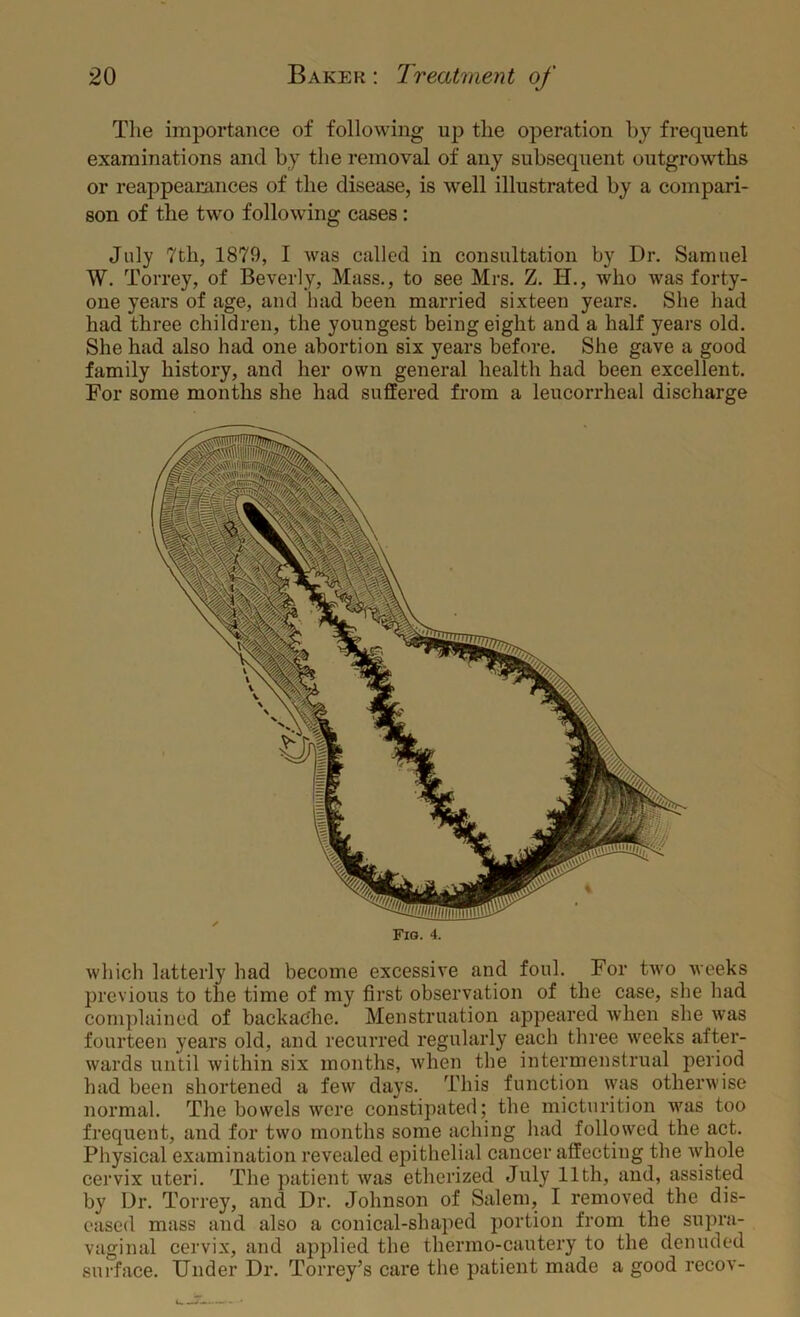 The importance of following up the operation hj frequent examinations and by the removal of any subsequent outgrowths or reappearances of the disease, is well illustrated by a compari- son of the two following cases: July 7th, 1879, I was called in consultation by Dr. Samuel W. Torrey, of Beverly, Mass., to see Mrs. Z. H., who was forty- one years of age, and had been married sixteen years. She had had three children, the youngest being eight and a half years old. She had also had one abortion six years before. She gave a good family history, and her own general health had been excellent. For some months she had suffered from a leucorrheal discharge Fig. 4. which latterly had become excessive and foul. For two weeks jarevious to the time of my first observation of the case, she had complained of backache. Menstruation appeared when she was fourteen years old, and recurred regularly each three weeks after- wards until Avithin six mouths, when the intermenstrual period had been shortened a few days. This function was otherwise normal. The bowels were constipated; the micturition was too frequent, and for two months some aching had followed the act. Physical examination revealed epithelial cancer alfecting the Avhole cervix uteri. The patient was etherized July 11th, and, assisted by Dr. Torrey, and Dr. Johnson of Salem, I removed the dis- eased mass and also a conical-shaped portion from the supra- vaginal cervix, and applied the thermo-cautery to the denuded surface. Under Dr. Torrey’s care the patient made a good recov-