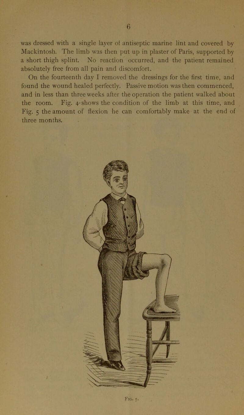 was dressed with a single layer of antiseptic marine lint and covered by Mackintosh. The limb was then put up in plaster of Paris, supported by a short thigh splint. No reaction occurred, and the patient remained absolutely free from all pain and discomfort. On the fourteenth day I removed the dressings for the first time, and found the wound healed perfectly. Passive motion was then commenced, and in less than three weeks after the operation the patient walked about the room. Fig. 4- shows the condition of the limb at this time, and Fig. 5 the amount of flexion he can comfortably make at the end of three months. Fig. e.