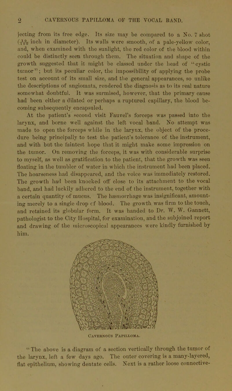 jecting from its free edge. Its size may be compared to a No. 7 shot (tA inch iQ diameter). Its walls were smooth, of a pale-yellow color, and, when examined with the sunlight, the red color of the blood within could be distinctly seen through them. The situation and shape of the growth suggested that it might bo classed under the head of “cystic tumor”; but its peculiar color, the impossibility of applying the probe test on account of its small size, and the general appearances, so unlike the descriptions of angiomata, rendered the diagnosis as to its real nature somewhat doubtful. It was surmised, however, that the primary cause had been either a dilated or perhaps a ruptured capillary, the blood be- coming subsequently encapsuled. At the patient’s second visit Fauvel’s forceps was passed into the larynx, and borne well against the left vocal band. No attempt was made to open the forceps while in the larynx, the object of the proce- dure being principally to test the patient’s tolerance of the instrument, and with but the faintest hope that it might make some impression on the tumor. On removing the forceps, it was with considerable surprise to myself, as well as gratification to the patient, that the growth was seen floating in the tumbler of water in which the instrument had been placed. The hoarseness had disappeared, and the voice was immediately restored. The growth had been knocked oft' close to its attachment to the vocal band, and had luckily adhered to the end of the instrument, together with a certain quantity of mucus. The haemorrhage was insignificant, amount- ing merely to a single drop cf blood. The growth was firm to the touch, and retained its globular form. It was handed to Dr. W. W. Gannett, pathologist to the City Hospital, for examination, and the subjoined report and drawing of the microscopical appearances were kindly furnished by him. “ The above is a diagram of a section vertically through the tumor of the larynx, left a few days ago. The outer covering is a many-layered, flat epithelium, showing dentate cells. Next is a rather loose connective-