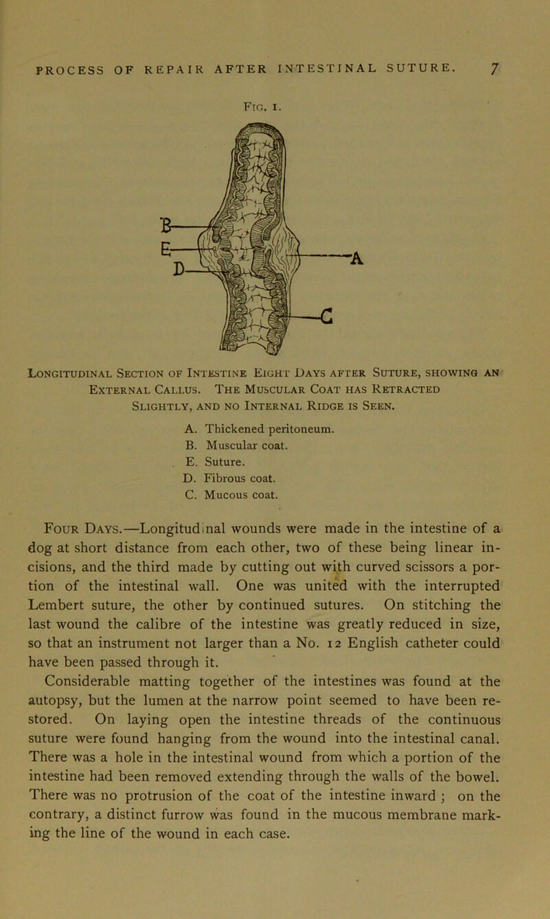 Fro. i. Longitudinal Section of Intestine Eight Days after Suture, showing an External Callus. The Muscular Coat has Retracted Slightly, and no Internal Ridge is Seen. A. Thickened peritoneum. B. Muscular coat. E. Suture. D. Fibrous coat. C. Mucous coat. Four Days.—Longitudinal wounds were made in the intestine of a dog at short distance from each other, two of these being linear in- cisions, and the third made by cutting out with curved scissors a por- tion of the intestinal wall. One was united with the interrupted Lembert suture, the other by continued sutures. On stitching the last wound the calibre of the intestine was greatly reduced in size, so that an instrument not larger than a No. 12 English catheter could have been passed through it. Considerable matting together of the intestines was found at the autopsy, but the lumen at the narrow point seemed to have been re- stored. On laying open the intestine threads of the continuous suture were found hanging from the wound into the intestinal canal. There was a hole in the intestinal wound from which a portion of the intestine had been removed extending through the walls of the bowel. There was no protrusion of the coat of the intestine inward ; on the contrary, a distinct furrow was found in the mucous membrane mark- ing the line of the wound in each case.