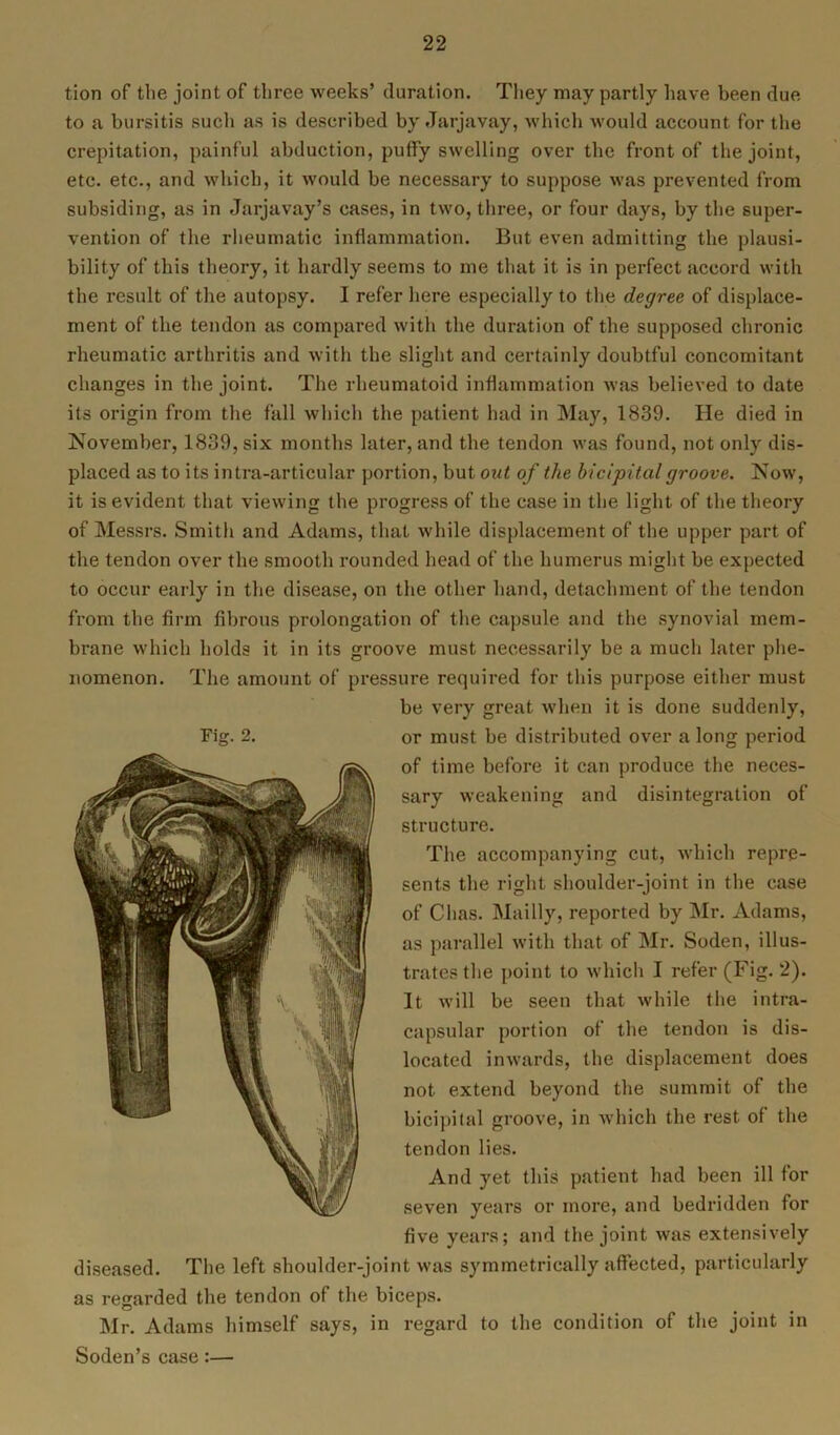 tion of the joint of three weeks’ duration. They may partly have been due to a bursitis such as is described by Jarjavay, which would account for the crepitation, painful abduction, puffy swelling over the front of the joint, etc. etc., and which, it would be necessary to suppose was prevented from subsiding, as in Jarjavay’s cases, in two, three, or four days, by the super- vention of the rheumatic inflammation. But even admitting the plausi- bility of this theory, it hardly seems to me that it is in perfect accord with the result of the autopsy. I refer here especially to the degree of displace- ment of the tendon as compared with the duration of the supposed chronic rheumatic arthritis and with the slight and certainly doubtful concomitant changes in the joint. The rheumatoid inflammation was believed to date its origin from the fall which the patient had in May, 1839. He died in November, 1839, six months later, and the tendon was found, not only dis- placed as to its intra-articular portion, but out of the bicipital groove. Now, it is evident that viewing the progress of the case in the light of the theory of Messrs. Smith and Adams, that while displacement of the upper part of the tendon over the smooth rounded head of the humerus might be expected to occur early in the disease, on the other hand, detachment of the tendon from the firm fibrous prolongation of the capsule and the synovial mem- brane which holds it in its groove must necessarily be a much later phe- nomenon. The amount of pressure required for this purpose either must be very great when it is done suddenly, or must be distributed over a long period of time before it can produce the neces- sary weakening and disintegration of structure. The accompanying cut, which repre- sents the right shoulder-joint in the case of Chas. Mailly, reported by Mr. Adams, as parallel with that of Mr. Soden, illus- trates the point to which I refer (Fig. 2). It will be seen that while the intra- capsular portion of the tendon is dis- located inwards, the displacement does not extend beyond the summit of the bicipital groove, in which the rest of the tendon lies. And yet this patient had been ill for seven years or more, and bedridden for five years; and the joint was extensively diseased. The left shoulder-joint was symmetrically affected, particularly as regarded the tendon of the biceps. Mr. Adams himself says, in regard to the condition of the joint in Soden’s case:—