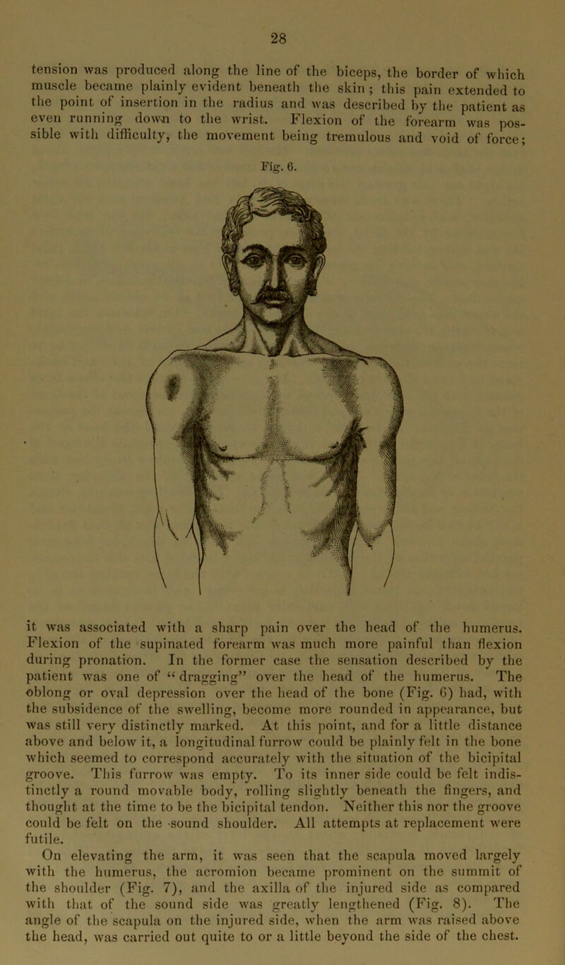 tension was produced along the line of the biceps, the border of which muscle became plainly evident beneath the skin ; this pain extended to the point of insertion in the radius and was described by the patient as even running down to the wrist. Flexion of the forearm was pos- sible with difficulty, the movement being tremulous and void of force; Fig. 6. it was associated with a sharp pain over the head of the humerus. Flexion of the supinated forearm was much more painful than flexion during pronation. In the former case the sensation described by the patient was one of “ dragging” over the head of the humerus. The oblong or oval depression over the head of the bone (Fig. G) had, with the subsidence of the swelling, become more rounded in appearance, but was still very distinctly marked. At this point, and for a little distance above and below it, a longitudinal furrow could be plainly felt in the bone which seemed to correspond accurately with the situation of the bicipital groove. This furrow was empty. To its inner side could be felt indis- tinctly a round movable body, rolling slightly beneath the fingers, and thought at the time to be the bicipital tendon. Neither this nor the groove could be felt on the sound shoulder. All attempts at replacement were futile. On elevating the arm, it was seen that the scapula moved largely with the humerus, the acromion became prominent on the summit of the shoulder (Fig. 7), and the axilla of the injured side as compared with that of the sound side was greatly lengthened (Fig. 8). The angle of the scapula on the injured side, when the arm was raised above the head, was carried out quite to or a little beyond the side of the chest.