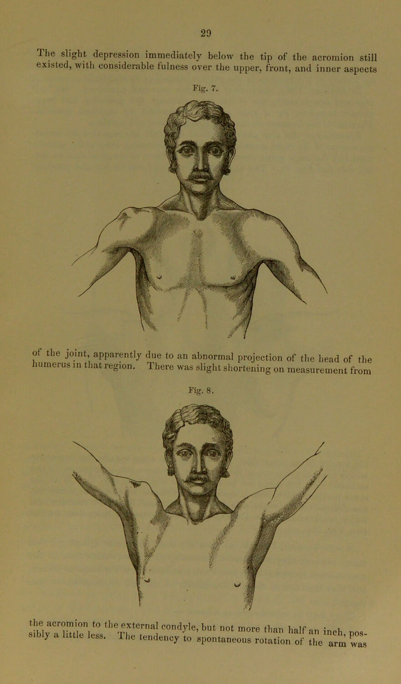 The slight depression immediately below the tip of the acromion still existed, with considerable fulness over the upper, front, and inner aspects Fig. 7. of the joint, apparently due to an abnormal projection of the head of the humerus in that region. There was slight shortening on measurement from Fig. 8. the acromion to the external condyle, but not more than half m bly a little less. The tendency to spontaneous rotation of an inch, pos- the arm was
