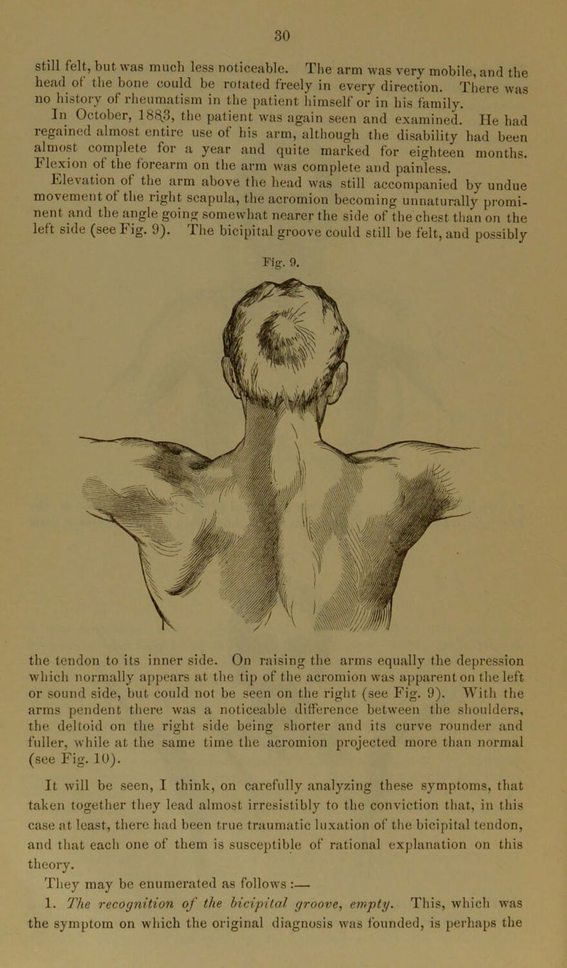 still felt, but was much less noticeable. The arm was very mobile, and the head of the bone could be rotated freely in every direction. There was no history of rheumatism in the patient himself or in his family. In October, 18$3, the patient was again seen and examined. He had regained almost entire use of his arm, although the disability had been almost complete for a year and quite marked for eighteen months. Flexion of the forearm on the arm was complete and painless. Elevation of the arm above the head was still accompanied by undue movement of the right scapula, the acromion becoming unnaturally promi- nent and the angle going somewhat nearer the side of the chest than on the left side (see Fig. 9). The bicipital groove could still be felt, and possibly Fig. 9. the tendon to its inner side. On raising the arms equally the depression which normally appears at the tip of the acromion was apparent on the left or sound side, but could not be seen on the right (see Fig. 9). With the arms pendent there was a noticeable difference between the shoulders, the deltoid on the right side being shorter and its curve rounder and fuller, while at the same time the acromion projected more than normal (see Fig. 10). It will be seen, I think, on carefully analyzing these symptoms, that taken together they lead almost irresistibly to the conviction that, in this case at least, there had been true traumatic luxation of the bicipital tendon, and that each one of them is susceptible of rational explanation on this theory. They may be enumerated as follows :— 1. The recognition of the bicipital groove, empty. This, which was the symptom on which the original diagnosis was founded, is perhaps the