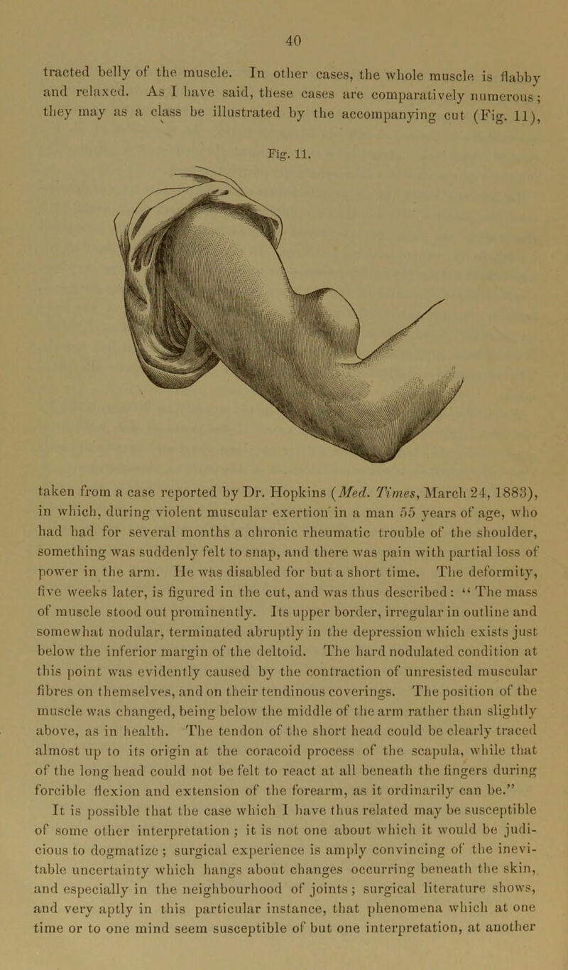 tracted belly of the muscle. In other cases, the whole muscle is flabby and relaxed. As 1 have said, these cases are comparatively numerous; they may as a class be illustrated by the accompanying cut (Fig. 11), Fig. 11. taken from a case reported by Dr. Hopkins {Med. Times, March 24, 1883), in which, during violent muscular exertion in a man 55 years of age, who had had for several months a chronic rheumatic trouble of the shoulder, something was suddenly felt to snap, and there was pain with partial loss of power in the arm. He was disabled for but a short time. The deformity, five weeks later, is figured in the cut, and was thus described: “ The mass of muscle stood out prominently. Its upper border, irregular in outline and somewhat nodular, terminated abruptly in the depression which exists just below the inferior margin of the deltoid. The hard nodulated condition at this point was evidently caused by the contraction of unresisted muscular fibres on themselves, and on their tendinous coverings. The position of the muscle was changed, being below the middle of the arm rather than slightly above, as in health. The tendon of the short head could be clearly traced almost up to its origin at the coracoid process of the scapula, while that of the long head could not be felt to react at all beneath the fingers during forcible flexion and extension of the forearm, as it ordinarily can be.” It is possible that the case which I have thus related may be susceptible of some other interpretation ; it is not one about which it would be judi- cious to dogmatize; surgical experience is amply convincing of the inevi- table uncertainty which hangs about changes occurring beneath the skin, and especially in the neighbourhood of joints; surgical literature shows, and very aptly in this particular instance, that phenomena which at one time or to one mind seem susceptible of but one interpretation, at auother