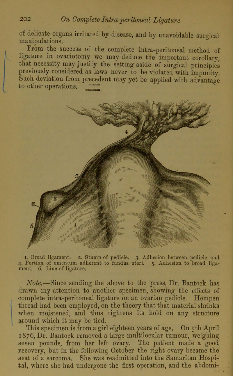 of delicate organs irritated by disease, and by unavoidable surgical manipulations. From the success of the complete iutra-peritoneal method of ligature in ovariotomy we may deduce the important corollary, that necessity may justify the setting aside of surgical principles previously considered as laws never to be violated with impunity. Such deviation from precedent may yet be applied with advantage to other operations. x MBm i. Broad ligament. 2. Stump of pedicle. 3. Adhesion between pedicle and 4. Portion of omentum adherent to fundus uteri. 5. Adhesion to broad liga- ment. 6. Line of ligature. Note.—Since sending the above to the press, Dr. Bantock has drawn my attention to another specimen, showing the effects of complete intra-peritoneal ligature on an ovarian pedicle. Hempen thread had been employed, on the theory that that material shrinks when moistened, and thus tightens its hold on any structure around which it may be tied. This specimen is from a girl eighteen years of age. On 5th April 1876, Dr. Bantock removed a large multilocular tumour, weighing seven pounds, from her left ovary. The patient made a good recovery, but in the following October the right ovary became the seat of a sarcoma. She was readmitted into the Samaritan Hospi- tal, where she had undergone the first operation, and the abdomi-