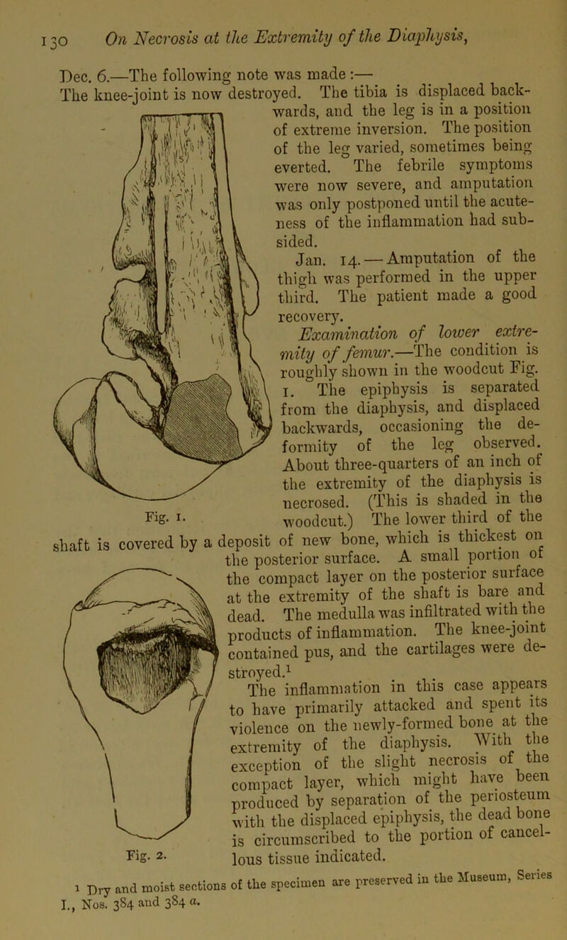 Dec. 6.—The following note was made :— The knee-joint is now destroyed. The tibia is displaced back- wards, and the leg is in a position of extreme inversion. The position of the leg varied, sometimes being everted. The febrile symptoms were now severe, and amputation was only postponed until the acute- ness of the inflammation had sub- sided. Jan. 14. — Amputation of the thigli was performed in the upper third. The patient made a good recovery. Examination of lower extre- mity of femur.—The condition is roughly shown in the woodcut Fig. 1, °The epiphysis is separated from the diaphysis, and displaced backwards, occasioning the de- formity of the leg observed.. About three-quarters of an inch of: the extremity of the diaphysis is necrosed. (This is shaded in the Fig. 1. woodcut.) The lower third of the shaft is covered by a deposit of new bone, which is thickest on the posterior surface. A small portion ot the compact layer on the posterior suiface at the extremity of the shaft is bare and dead. The medulla was infiltrated with the products of inflammation. The knee-joint contained pus, and the cartilages were de- stroyed.1 The inflammation in this case appears to have primarily attacked and spent its violence on the newly-formed bone at the extremity of the diaphysis. With tie exception of the slight necrosis of the compact layer, which might have been produced by separation of the periosteum with the displaced epiphysis, the dead bone is circumscribed to the portion of cancel- Fig- 2. ious tissue indicated. 1 Dry and moist sections of the specimen are preserved in the Museum, Series I., Nos. 384 and 384 a.