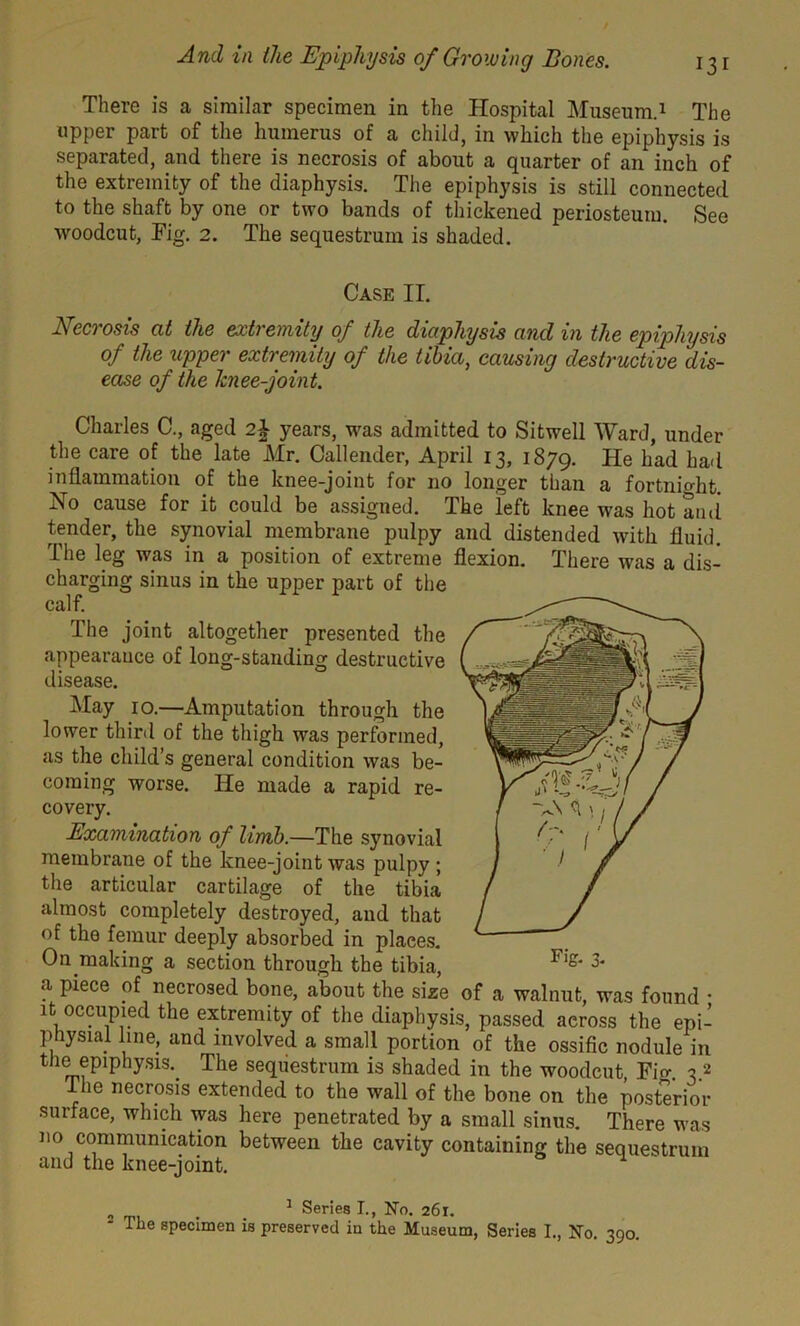 There is a similar specimen in the Hospital Museum.1 The upper part of the humerus of a child, in which the epiphysis is separated, and there is necrosis of about a quarter of an inch of the extremity of the diaphysis. The epiphysis is still connected to the shaft by one or two bands of thickened periosteum. See woodcut, Fig. 2. The sequestrum is shaded. Case II. Necrosis at the extremity of the diaphysis and in the epiphysis of the upper extremity of the tibia, causing destructive dis- ease of the knee-joint. Charles C., aged 2\ years, was admitted to Sitwell Ward, under the care of the late Mr. Callender, April 13, 1879. He had had inflammation of the knee-joint for no longer than a fortnio-ht. No cause for it could be assigned. The left knee was hot and tender, the synovial membrane pulpy and distended with fluid. The leg was in a position of extreme flexion. There was a dis- charging sinus in the upper part of the calf. The joint altogether presented the appearance of long-standing destructive disease. May 10.—Amputation through the lower third of the thigh was performed, as the child’s general condition was be- coming worse. He made a rapid re- covery. Examination of limb.—The synovial membrane of the knee-joint was pulpy ; the articular cartilage of the tibia almost completely destroyed, and that of the femur deeply absorbed in plaees. On making a section through the tibia, a piece of necrosed bone, about the size of a walnut, was found • it occupied the extremity of the diaphysis, passed across the epi- physial line, and involved a small portion of the ossific nodule in the ep^hysis. The sequestrum is shaded in the woodcut Fig 3 2 Ihe necrosis extended to the wall of the bone on the posterior surface, which was here penetrated by a small sinus. There was no communication between the cavity containing the sequestrum and the knee-joint. 1 Series I., No. 261.
