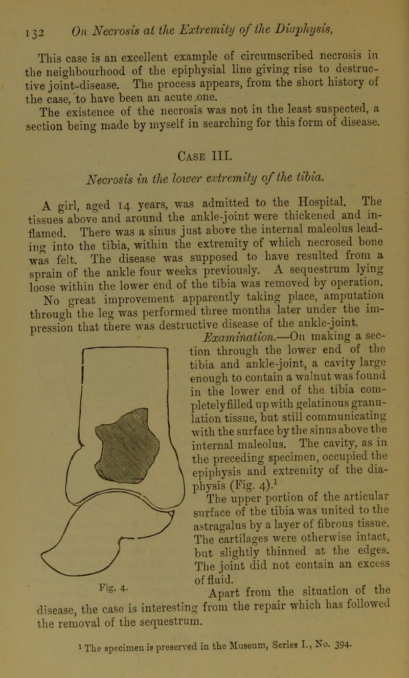 This case is an excellent example of circumscribed necrosis in the neighbourhood of the epiphysial line giving rise to destruc- tive joint-disease. The process appears, from the short history of the case, 'to have been an acute .one. The existence of the necrosis was not in the least suspected, a section being made by myself in searching for this form of disease. Case III. Necrosis in the lower extremity of the tibia. A girl, aged 14 years, was admitted to the Hospital. The tissues above and around the ankle-joint were thickened and in- flamed. There was a sinus just above the internal maleolus lead- ing into the tibia, within the extremity of which necrosed bone was felt. The disease was supposed to have resulted from a sprain of the ankle four weeks previously. A sequestrum lying loose within the lower end of the tibia was removed by operation. No great improvement apparently taking place, amputation through the leg was performed three months later under the im- pression that there was destructive disease of the ankle-joint. Examination.—On making a sec- tion through the lower end of the tibia and ankle-joint, a cavity large enough to contain a walnut was found in the lower end of the tibia com- pletely filled up with gelatinous granu- lation tissue, but still communicating with the surface by the sinus above the internal maleolus. The cavity, as in the preceding specimen, occupied the epiphysis and extremity of the dia- physis (Fig. 4)-1 The upper portion of the articular surface of the tibia was united to the astragalus by a layer of fibrous tissue. The cartilages were otherwise intact, but slightly thinned at the edges. The joint did not contain an excess of fluid. Apart from the situation of the disease, the case is interesting from the repair which has followed the removal of the sequestrum. Fig. 4-