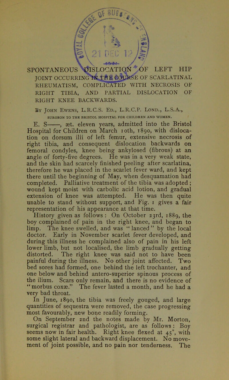 SPONTANEOU JOINT OCCUR OF LEFT HIP E OF SCARLATINAL RHEUMATISM, COMPLICATED WITH NECROSIS OF RIGHT TIBIA, AND PARTIAL DISLOCATION OF RIGHT KNEE BACKWARDS. By John Ewens, L.R.C.S. Ed., L.R.C.P. Lond., L.S.A., E. S , aet. eleven years, admitted into the Bristol Hospital for Children on March ioth, 1890, with disloca- tion on dorsum ilii of left femur, extensive necrosis of right tibia, and consequent dislocation backwards on femoral condyles, knee being ankylosed (fibrous) at an angle of forty-five degrees. He was in a very weak state, and the skin had scarcely finished peeling after scarlatina, therefore he was placed in the scarlet fever ward, and kept there until the beginning of May, when desquamation had completed. Palliative treatment of the tibia was adopted ; wound kept moist with carbolic acid lotion, and gradual extension of knee was attempted. He was then quite unable to stand without support, and Fig. 1 gives a fair representation of his appearance at that time. History given as follows: On October 23rd, 1889, the boy complained of pain in the right knee, and began to limp. The knee swelled, and was “ lanced ” by the local doctor. Early in November scarlet fever developed, and during this illness he complained also of pain in his left lower limb, but not localised, the limb gradually getting distorted. The right knee was said not to have been painful during the illness. No other joint affected. Two bed sores had formed, one behind the left trochanter, and one below and behind antero-superior spinous process of the ilium. Scars only remain, and there is no evidence of “morbus coxae.” The fever lasted a month, and he had a very bad throat. In June, 1890, the tibia was freely gouged, and large quantities of sequestra were removed, the case progressing most favourably, new bone readily forming. On September 2nd the notes made by Mr. Morton, surgical registrar and pathologist, are as follows : Boy seems now in fair health. Right knee flexed at 450, with some slight lateral and backward displacement. No move- ment of joint possible, and no pain nor tenderness. The SURGEON TO THE BRISTOL HOSPITAL FOR CHILDREN AND WOMEN.