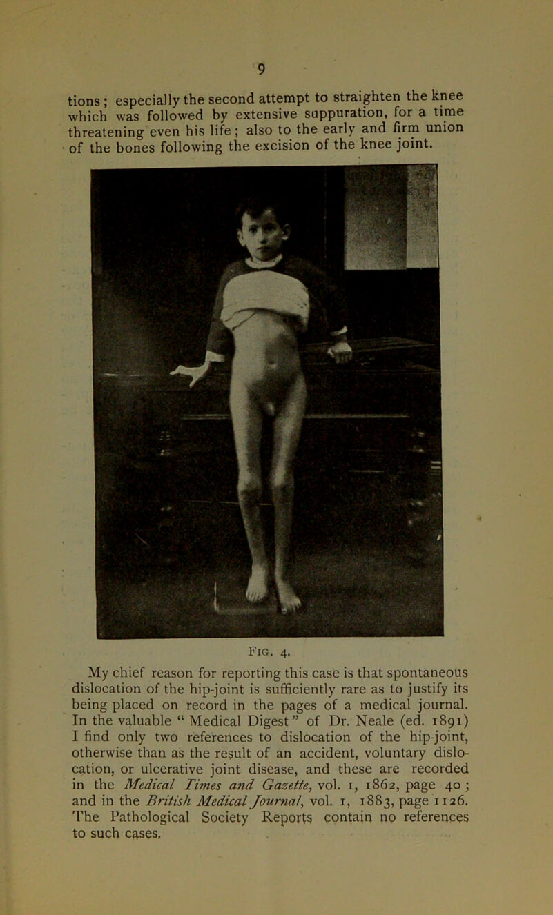 tions ; especially the second attempt to straighten the knee which was followed by extensive suppuration, for a time threatening even his life; also to the early and firm union of the bones following the excision of the knee joint. Fig. 4. My chief reason for reporting this case is that spontaneous dislocation of the hip-joint is sufficiently rare as to justify its being placed on record in the pages of a medical journal. In the valuable “ Medical Digest” of Dr. Neale (ed. 1891) I find only two references to dislocation of the hip-joint, otherwise than as the result of an accident, voluntary dislo- cation, or ulcerative joint disease, and these are recorded in the Medical Times and Gazette, vol. 1, 1862, page 40 ; and in the British Medical Journal, vol. 1, 1883, page 1126. The Pathological Society Reports contain no references to such cases,