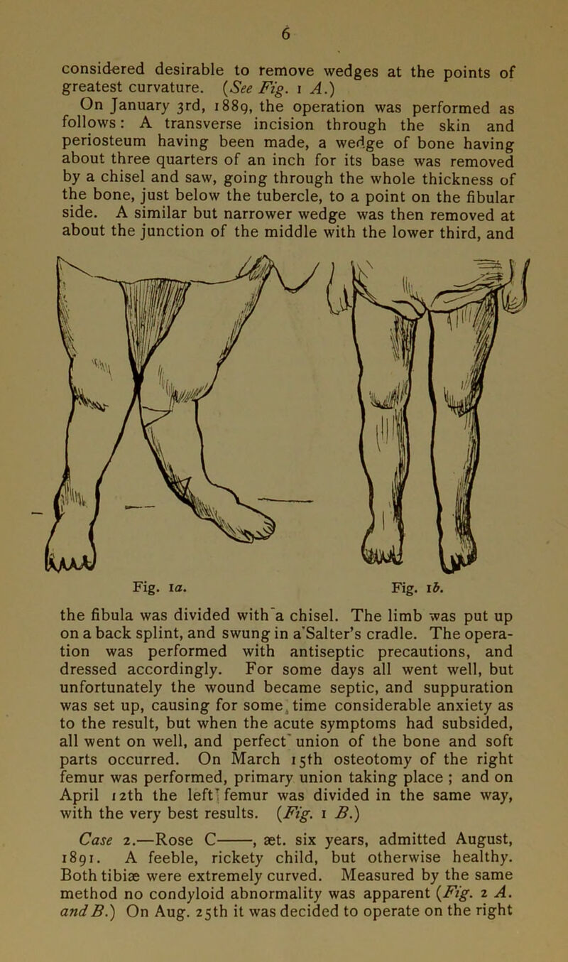 considered desirable to remove wedges at the points of greatest curvature. (See Fig. i A.) On January 3rd, 1889, the operation was performed as follows: A transverse incision through the skin and periosteum having been made, a wedge of bone having about three quarters of an inch for its base was removed by a chisel and saw, going through the whole thickness of the bone, just below the tubercle, to a point on the fibular side. A similar but narrower wedge was then removed at about the junction of the middle with the lower third, and the fibula was divided with a chisel. The limb was put up on a back splint, and swung in a'Salter’s cradle. The opera- tion was performed with antiseptic precautions, and dressed accordingly. For some days all went well, but unfortunately the wound became septic, and suppuration was set up, causing for some time considerable anxiety as to the result, but when the acute symptoms had subsided, all went on well, and perfect union of the bone and soft parts occurred. On March 15th osteotomy of the right femur was performed, primary union taking place ; and on April 12th the left7 femur was divided in the same way, with the very best results. (Fig. 1 B.) Case 2.—Rose C , aet. six years, admitted August, 1891. A feeble, rickety child, but otherwise healthy. Both tibiae were extremely curved. Measured by the same method no condyloid abnormality was apparent (Fig. 2 A. andB.) On Aug. 25th it was decided to operate on the right
