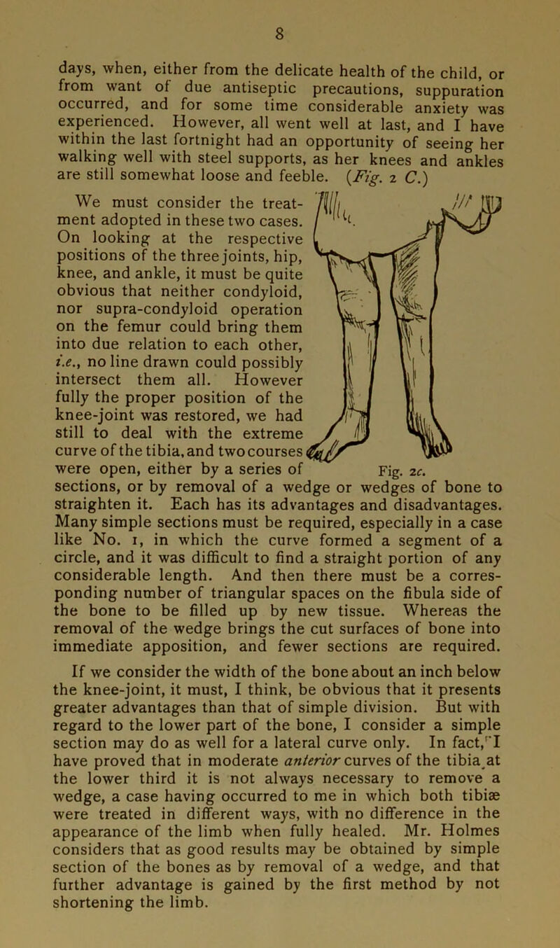 days, when, either from the delicate health of the child, or from want of due antiseptic precautions, suppuration occurred, and for some time considerable anxiety was experienced. However, all went well at last, and I have within the last fortnight had an opportunity of seeing her walking well with steel supports, as her knees and ankles are still somewhat loose and feeble. {Fig. 2 C.) We must consider the treat- ment adopted in these two cases. On looking at the respective positions of the three joints, hip, knee, and ankle, it must be quite obvious that neither condyloid, nor supra-condyloid operation on the femur could bring them into due relation to each other, i.e.y no line drawn could possibly intersect them all. However fully the proper position of the knee-joint was restored, we had still to deal with the extreme curve of the tibia,and twocoursesi were open, either by a series of sections, or by removal of a wedge or wedges of bone to straighten it. Each has its advantages and disadvantages. Many simple sections must be required, especially in a case like No. 1, in which the curve formed a segment of a circle, and it was difficult to find a straight portion of any considerable length. A.nd then there must be a corres- ponding number of triangular spaces on the fibula side of the bone to be filled up by new tissue. Whereas the removal of the wedge brings the cut surfaces of bone into immediate apposition, and fewer sections are required. Fig. 2c. If we consider the width of the bone about an inch below the knee-joint, it must, I think, be obvious that it presents greater advantages than that of simple division. But with regard to the lower part of the bone, I consider a simple section may do as well for a lateral curve only. In fact/'I have proved that in moderate anterior curves of the tibia at the lower third it is not always necessary to remove a wedge, a case having occurred to me in which both tibiae were treated in different ways, with no difference in the appearance of the limb when fully healed. Mr. Holmes considers that as good results may be obtained by simple section of the bones as by removal of a wedge, and that further advantage is gained by the first method by not shortening the limb.