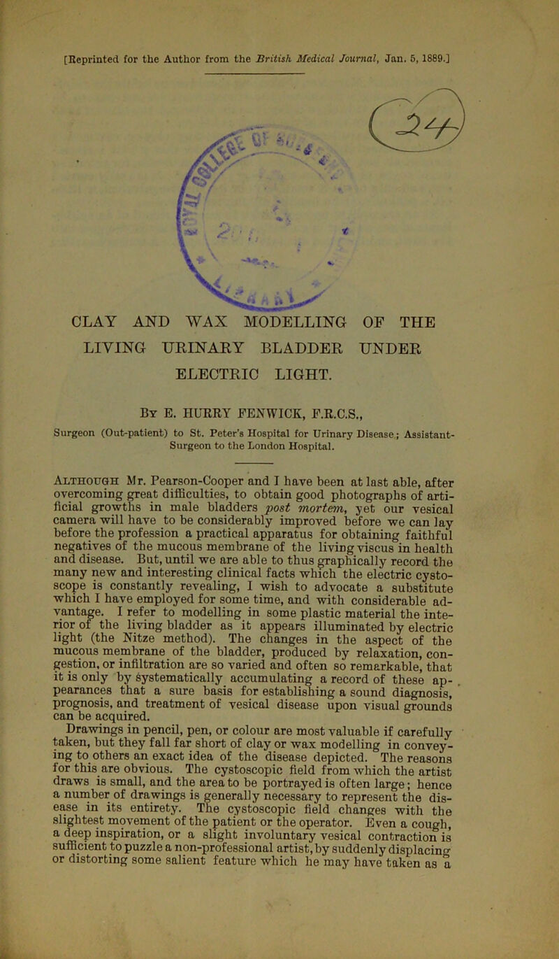 [Keprinted for the Author from the British Medical Journal, Jan. 5,1889.] CLAY AND WAX MODELLING LIVING URINAKY BLADDER ELECTRIC LIGHT. OF THE UNDER By E. hurry FENWICK, F.R.C.S., Surgeon (Out-patient) to St. Peter’s Hospital for Urinary Disease.; Assistant- Surgeon to the London Hospital. Although Mr. Pearson-Cooper and I have been at last able, after overcoming great difficulties, to obtain good photographs of arti- ficial growths in male bladders post mortem, yet our vesical camera will have to be considerably improved before we can lay before the profession a practical apparatus for obtaining faithful negatives of the mucous membrane of the living viscus in health and disease. But, until we are able to thus graphically record the many new and interesting clinical facts which the electric cysto- scope is constantly revealing, I wish to advocate a substitute which I have employed for some time, and with considerable ad- vantage. I refer to modelling in some plastic material the inte- rior of the living bladder as it appears illuminated by electric light (the Nitze method). The changes in the aspect of the mucous membrane of the bladder, produced by relaxation, con- gestion. or infiltration are so varied and often so remarkable, that it is only by systematically accumulating a record of these ap- pearances that a sure basis for establishing a sound diagnosis, prognosis, and treatment of vesical disease upon visual grounds can be acquired. Drawings in pencil, pen, or colour are most valuable if carefully taken, but they fall far short of clay or wax modelling in convey- ing to others an exact idea of the disease depicted. The reasons for this are obvious. The cystoscopic field from which the artist draws is small, and the area to be portrayed is often large; hence a number of drawings is generally necessary to represent the dis- ease in its entirety. The cystoscopic field changes with the slightest movement of the patient or the operator. Even a cough, a deep inspiration, or a slight involuntary vesical contraction is sufficient to puzzle a non-professional artist, by suddenly displacing or distorting some salient feature which he may have taken as a