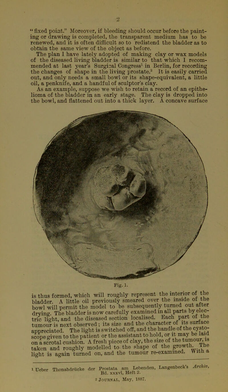 “ fixed poiat.” Moreover, if bleeding should occur before the paint- ing or drawing is completed, the transparent medium has to be renewed, and it is often difficult so to redistend the bladder as to obtain the same view of the object as before. The plan 1 have lately adopted of making clay or wax models of the diseased living bladder is similar to that which I recom- mended at last year’s Surgical Congress^ in Berlin, for recording the changes of shape in the living prostate.^ It is easily carried out, and only needs a small bowl or its shape-equivalent, a little oil, a penknife, and a handful of sculptor’s clay. As an example, suppose we wish to retain a record of an epithe- lioma of the bladder in an early stage. The clay is dropped into the bowl, and flattened out into a thick layer. A concave surface Fig. 1. is thus formed, which will roughly represent the interior of the bladder. A little oil previously smeared over the inside of the bowl will permit the model to be subsequently turned out after drying. The bladder is now carefully examined in all parts by elec- tric light, and the diseased section localised. Each part of the tumoim is next observed; its size and the character of its sur^ce appreciated. The light is switched off, and the handle of the cysto- scope given to the patient or the assistant to hold, or it may ® on a scrotal cushion. A fresh piece of clay, the size of the^mour, is taken and roughly modelled to the shape of the light is again turned on, and the tumour re-exammed. lUeber Thonabdriicke der Prostata am Lebenden, Langenbeck’s ArcAiv, Bd. xxxvi, Heft 2.