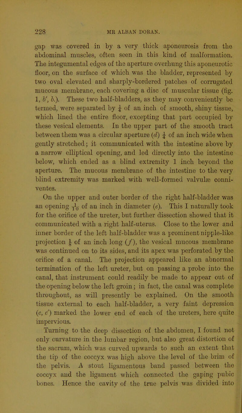 gap was covered in by a very thick aponeurosis from the abdominal muscles, often seen in this kind of malformation. The integumental edges of the aperture overhung this aponeurotic floor, on the surface of which was the bladder, represented by two oval elevated and sharply-bordered patches of corrugated mucous membrane, each covering a disc of muscular tissue (fig. 1, V, b.). These two half-bladders, as they may conveniently be termed, were separated by ^ of an inch of smooth, shiny tissue, which lined the entire floor, excepting that part occupied by tliese vesical elements. In the upper part of the smooth tract between them was a circular aperture {d) ^ of an inch wide when gently stretched; it communicated with the intestine above by a narrow elliptical opening, and led directly into the intestine below, which ended as a blind extremity 1 inch beyond the aperture. The mucous membrane of the intestine to the very blind extremity was marked with well-formed valvulse conni- ventes. On the upper and outer border of the right half-bladder was an opening of an inch in diameter (e). Tliis I naturally took for the orifice of the ureter, but further dissection showed that it communicated with a right half-uterus. Close to the lower and inner border of the left half-bladder was a prominent nipple-like projection ^ of an inch long (/), the vesical mucous membrane was continued on to its sides, and its apex was perforated by the orifice of a canal. The projection appeared like an abnormal termination of the left ureter, but on passing a probe into the canal, that instrument could readily be made to appear out of the opening below the left groin; in fact, the canal was complete throughout, as will presently be explained. On the smooth tissue external to each half-bladder, a very faint depression (c, c') marked the lower end of each of the ureters, here quite impervious. Turning to the deep dissection of the abdomen, I found not only curvature in the lumbar region, but also great distortion of the sacrum, which was curved upwards to such an extent that the tip of the coccyx was high above the level of the brim of the pelvis. A stout ligamentous band passed between the coccyx and the ligament which connected the gaping pubic bones. Hence the cavity of the true pelvis was divided into