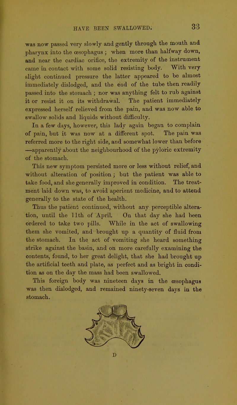 was now passed very slowly and gently through the mouth and pharynx into the oesophagus ; when more than halfway down, and near the cardiac orifice, the extremity of the instrument came in contact with some solid resisting body. With very slight continued pressure the latter appeared to be almost immediately dislodged, and the end of the tube then readily passed into the stomach ; nor was anything felt to rub against it or resist it on its withdrawal. The patient immediately expressed herself relieved from the pain, and was now able to swallow solids and liquids without difficulty. In a few days, however, this lady again began to complain of pain, but it was now at a different spot. The pain was referred more to the right side, and somewhat lower than before —apparently about the neighbourhood of the pyloric extremity of the stomach. This new symptom persisted more or less without relief, and without alteration of position ; but the patient was able to take food, and she generally improved in condition. The treat- ment laid down was, to avoid aperient medicine, and to attend generally to the state of the health. Thus the patient continued, without any perceptible altera- tion, until the 11th of April. On that day she had been ordered to take two pills. While in the act of swallowing them she vomited, and brought up a quantity of fluid from the stomach. In the act of vomiting she heard something strike against the basin, and on more carefully examining the contents, found, to her great delight, that she had brought up the artificial teeth and plate, as perfect and as bright in condi- tion as on the day the mass had been swallowed. This foreign body was nineteen days in the oesophagus was then dislodged, and remained ninety-seven days in the stomach. D