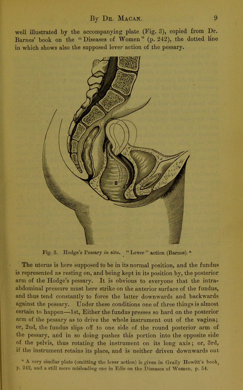 well illustrated by the accompanying plate (Fig. 3), copied from Dr. Barnes’ book on the “Diseases of Women” (p. 242), the dotted line in which shows also the supposed lever action of the pessary. Fig. 3. Hodge’s Pessary in situ. “ Lever ” action (Barnes). a The uterus is here supposed to be in its normal position, and the fundus is represented as resting on, and being kept in its position by, the posterior arm of the Hodge’s pessary. It is obvious to everyone that the intra- abdominal pressure must here strike on the anterior surface of the fundus, and thus tend constantly to force the latter downwards and backwards against the pessary. Under these conditions one of three things is almost certain to happen—1st, Either the fundus presses so hard on the posterior arm of the pessary as to drive the whole instrument out of the vagina; or, 2nd, the fundus slips off to one side of the round posterior arm of the pessary, and in so doing pushes this portion into the opposite side of the pelvis, thus rotating the instrument on its long axis; or, 3rd, if the instrument retains its place, and is neither driven downwards out 11 A very similar plate (omitting the lever action) is given in Graily Hewitt’s bookf p. 242, and a still more misleading one in Edis on the Diseases of Women, p. 54.