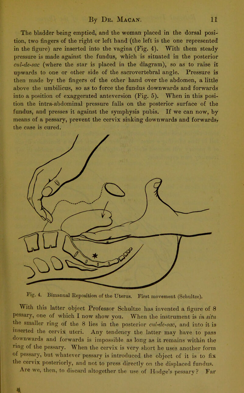 The bladder being emptied, and the woman placed in the dorsal posi- tion, two fingers of the right or left hand (the left is the one represented in the figure) are inserted into the vagina (Fig. 4). With them steady pressure is made against the fundus, which is situated in the posterior cul-de-sac (where the star is placed in the diagram), so as to raise it upwards to one or other side of the sacrovertebral angle. Pressure is then made by the fingers of the other hand over the abdomen, a little above the umbilicus, so as to force the fundus downwards and forwards into a position of exaggerated anteversion (Fig. 5). When in this posi- tion the intra-abdominal pressure falls on the posterior surface of the fundus, and presses it against the symphysis pubis. If we can now, by means of a pessary, prevent the cervix sinking downwards and forwards? the case is cured. Fig. 4. Bimanual Reposition of the Uterus. First movement (Schultze). With this latter object Professor Schultze has invented a figure of 8 pessary, one of which I now show you. When the instrument is in situ the smaller ring of the 8 lies in the posterior cul-de-sac, and into it is inserted the cervix uteri. Any tendency the latter may have to pass downwards and forwards is impossible as long as it remains within the ring of the pessary. When the cervix is very short he uses another form of pessary, but whatever pessary is introduced the object of it is to fix the cervix posteriorly, and not to press directly on the displaced fundus. Aie we, then, to discard altogether the use of Hodge’s pessary? Far