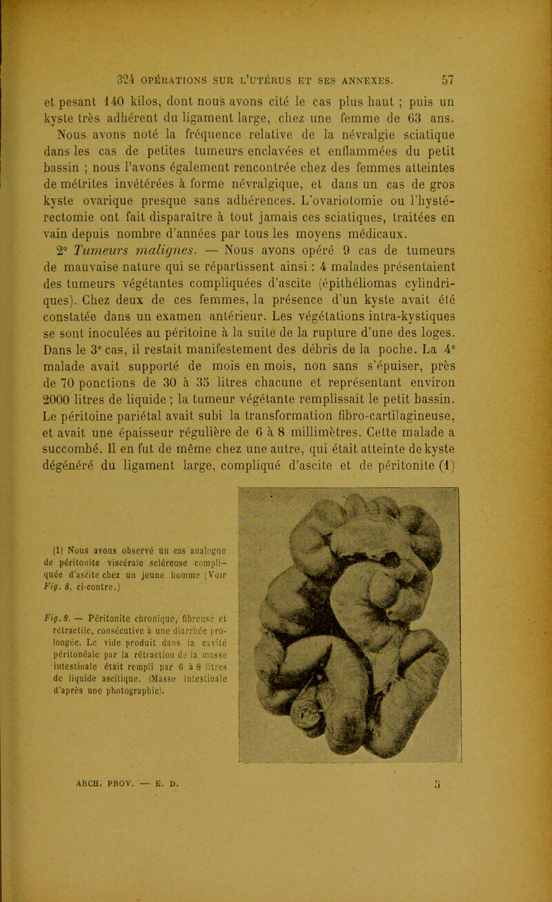 et pesant 140 kilos, dont nous avons cité le cas plus haut ; puis un kyste très adhérent du ligament large, chez une femme de 03 ans. Nous avons noté la fréquence relative de la névralgie sciatique dans les cas de petites tumeurs enclavées et enflammées du petit bassin ; nous l’avons également rencontrée chez des femmes atteintes de métriles invétérées à forme névralgique, et dans un cas de gros kyste ovarique presque sans adhérences. L’ovariotomie ou l’hysté- rectomie ont fait disparaître à tout jamais ces sciatiques, traitées en vain depuis nombre d’années par tous les moyens médicaux. 2° Tumeurs malignes. — Nous avons opéré 9 cas de tumeurs de mauvaise nature qui se répartissent ainsi : 4 malades présentaient des tumeurs végétantes compliquées d’ascite (épithéliomas cylindri- ques). Chez deux de ces femmes, la présence d’un kyste avait été constatée dans un examen antérieur. Les végétations intra-kystiques se sont inoculées au péritoine à la suite de la rupture d’une des loges. Dans le 3e cas, il restait manifestement des débris de la poche. La 4e malade avait supporté de mois en mois, non sans s’épuiser, près de 70 pondions de 30 à 33 litres chacune et représentant environ 2000 litres de liquide ; la tumeur végétante remplissait le petit bassin. Le péritoine pariétal avait subi la transformation fibro-cartilagineuse, et avait une épaisseur régulière de 6 à 8 millimètres. Cette malade a succombé. Il en fut de même chez une autre, qui était atteinte de kyste dégénéré du ligament large, compliqué d’ascite et de péritonite (1) (1) Nous avons observé un cas analogue de péritonite viscérale scléreuse compli- quée d’ascite chez un jeune homme (Voir Fig. S, ci-contre.) Fig. 8.— Péritonite chronique, fibreuse et rétractile, consécutive h une diarrhée pro- longée. Le vide produit dans la cavité péritonéale par la rétraction de la masse intestinale était rempli par 6 à 8 litres de liquide ascitique. (Masse intestinale d’après une photographie). ARCH. PROV. — E. D.