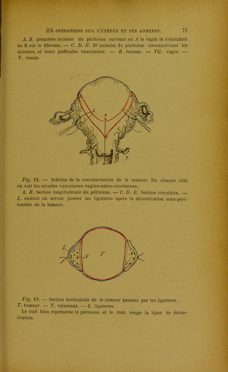 A. B. première incision du péritoine ouvrant en A le vagin et s’étendant en B sur le fibrome. — C. D. E. 2e incision du péritoine circonscrivant les annexes, et leurs pédicules vasculaires. — R. rectum. — VG. vagin. — V. vessie. Fig. 12. — Schéma de la vascularisation de la tumeur. De chaque côté on voit les arcades vasculaires vagino-utéro-ovariennes. A. B. Section longitudinale du péritoine. — C. D. E. Section circulaire. — L. endroit où seront posées les ligatures après la décortication sous-péri- tonéale de la tumeur. Fig. 13. — Section horizontale de la tumeur passant par les ligatures. T. tumeur. — V. vaisseaux. — L. ligatures. Le trait bleu représente le péritoine, et le trait rouge la ligne de décor- tication.