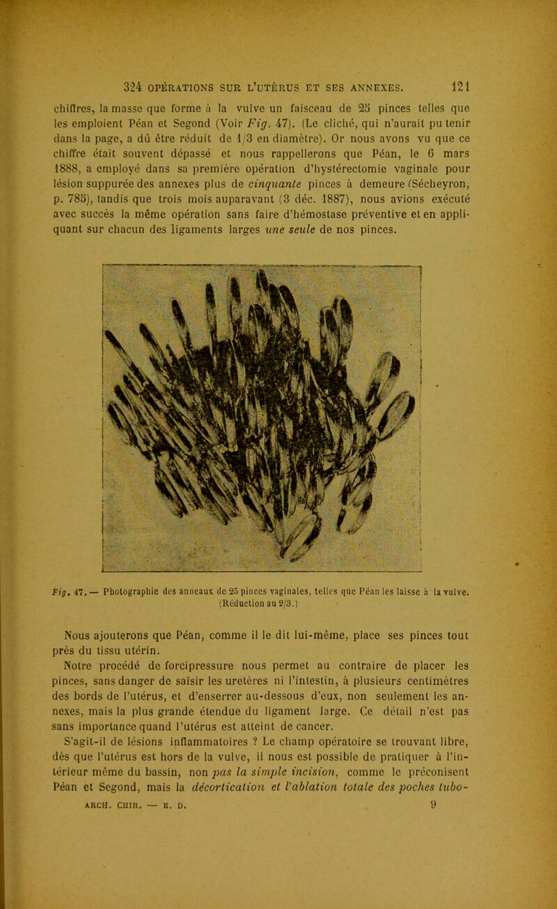 chiffres, la masse que forme à la vulve un faisceau de 23 pinces telles que les emploient Péan et Segond (Voir Fig. 47). (Le cliché, qui n’aurait pu tenir dans la page, a dû être réduit de 1/3 en diamètre). Or nous avons vu que ce chiffre était souvent dépassé et nous rappellerons que Péan, le G mars 1888, a employé dans sa première opération d’hystérectomie vaginale pour lésion suppurée des annexes plus de cinquante pinces à demeure (Sécheyron, p. 785), tandis que trois mois auparavant (3 déc. 1887), nous avions exécuté avec succès la même opération sans faire d’hémostase préventive et en appli- quant sur chacun des ligaments larges une seule de nos pinces. Fig. 47.— Photographie des anneaux de 25 pinces vaginales, telles que Péan les laisse h la vulve. (Réduction au 2/3.) Nous ajouterons que Péan, comme il le dit lui-même, place ses pinces tout près du tissu utérin. Notre procédé de forcipressure nous permet au contraire de placer les pinces, sans danger de saisir les uretères ni l’intestin, à plusieurs centimètres des bords de l’utérus, et d’enserrer au-dessous d’eux, non seulement les an- nexes, mais la plus grande étendue du ligament large. Ce détail n’est pas sans importance quand l’utérus est atteint de cancer. S’agit-il de lésions inflammatoires ? Le champ opératoire se trouvant libre, dès que l’utérus est hors de la vulve, il nous est possible de pratiquer à l’in- térieur même du bassin, non pas la simple incision, comme le préconisent Péan et Segond, mais la décortication et l'ablation totale des poches lubo- 9 ARCH. CUIR. — K. I).