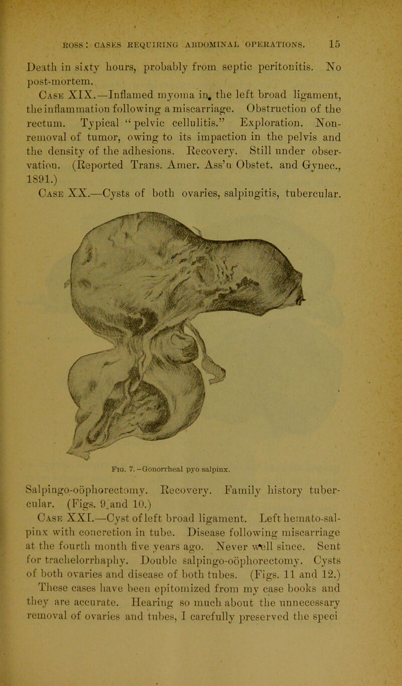 Death in sixty hours, probably from septic peritonitis. No post-mortem. Case XIX.—Inflamed myoma in. the left broad ligament, the inflammation following a miscarriage. Obstruction of the rectum. Typical “ pelvic cellulitis.” Exploration. Non- removal of tumor, owing to its impaction in the pelvis and the density of the adhesions. Recovery. Still under obser- vation. (Reported Trans. Amer. Ass’u Obstet. and Gynec., 1891.) Case XX.—Cysts of both ovaries, salpingitis, tubercular. Fig. 7.-Gonorrheal pyo salpinx. Salpingo-oophorectoniy. Recovery. Family history tuber- cular. (Figs. 9_and 10.) Case XXL—Cyst of left broad ligament. Left hemato-sal- pinx with concretion in tube. Disease following miscarriage at the fourth month five years ago. Never w*ell since. Sent for trachelorrhaphy. Double salpingo-oophorectoniy. Cysts of both ovaries and disease of both tubes. (Figs. 11 and 12.) These cases have been epitomized from my case books and they are accurate. Hearing so much about the unnecessary removal of ovaries and tubes, I carefully preserved the speci