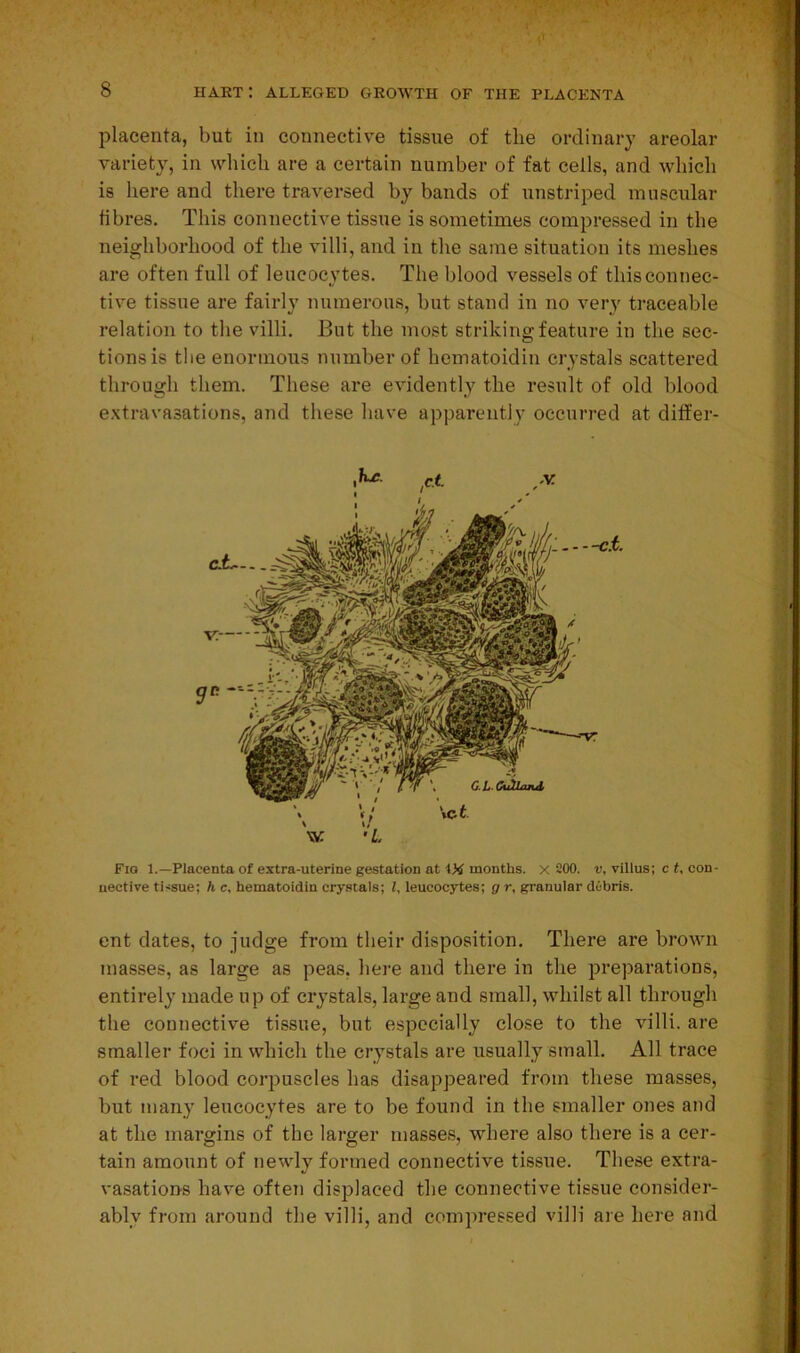 placenta, but in connective tissue of the ordinary areolar variety, in which are a certain number of fat cells, and which is here and there traversed by bands of unstriped muscular fibres. This connective tissue is sometimes compressed in the neighborhood of the villi, and in the same situation its meshes are often full of leucocytes. The blood vessels of this connec- tive tissue are fairly numerous, but stand in no very traceable relation to the villi. But the most striking feature in the sec- tions is the enormous number of hematoidin crystals scattered through them. These are evidently the result of old blood extravasations, and these have apparently occurred at differ- M r.t ,v • ' Fig L—Placenta of extra-uterine gestation at months. X 200. v, villus; c t, con- nective tissue; h c, hematoidin crystals; l, leucocytes; g r, granular debris. ent dates, to judge from their disposition. There are brown masses, as large as peas, here and there in the preparations, entirely made up of crystals, large and small, whilst all through the connective tissue, but especially close to the villi, are smaller foci in which the crystals are usually small. All trace of red blood corpuscles has disappeared from these masses, but many leucocytes are to be found in the smaller ones and at the margins of the larger masses, where also there is a cer- tain amount of newly formed connective tissue. These extra- vasations have often displaced the connective tissue consider- ably from around the villi, and compressed villi are here and