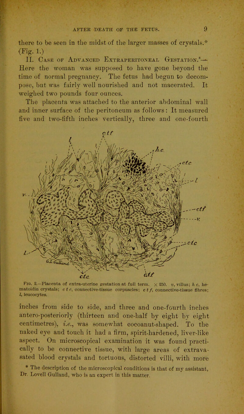 there to be seen in the midst of the larger masses of crystals.* (Fig- 1.) II. Ca.se of Advanced Extraperitoneal Gestation.6-^ Here the woman was supposed to have gone beyond the time of normal pregnancy. The fetus had begun to decom- pose, but was fairly well nourished and not macerated. It weighed two pounds four ounces. The placenta was attached to the anterior abdominal wall and inner surface of the peritoneum as follows: It measured five and two-fifth inches vertically, three and one-fourth c.tr Fig. 2.—Placenta of extra-uterine gestation at full term, x 250. v, villus; h c, he- matoidin crystals; c t r, connective-tissue corpuscles; ctf, connective-tissue fibres; Z, leucocytes. inches from side to side, and three and one-fourth inches antero-posteriorly (thirteen and one-half by eight by eight centimetres), i.e., was somewhat cocoanut-shaped. To the naked eye and touch it had a firm, spirit-hardened, liver-like aspect. On microscopical examination it was found practi- cally to be connective tissue, with large areas of extrava- sated blood crystals and tortuous, distorted villi, with more * The description of the microscopical conditions is that of my assistant, Dr. Lovell Gulland, who is an expert in this matter.