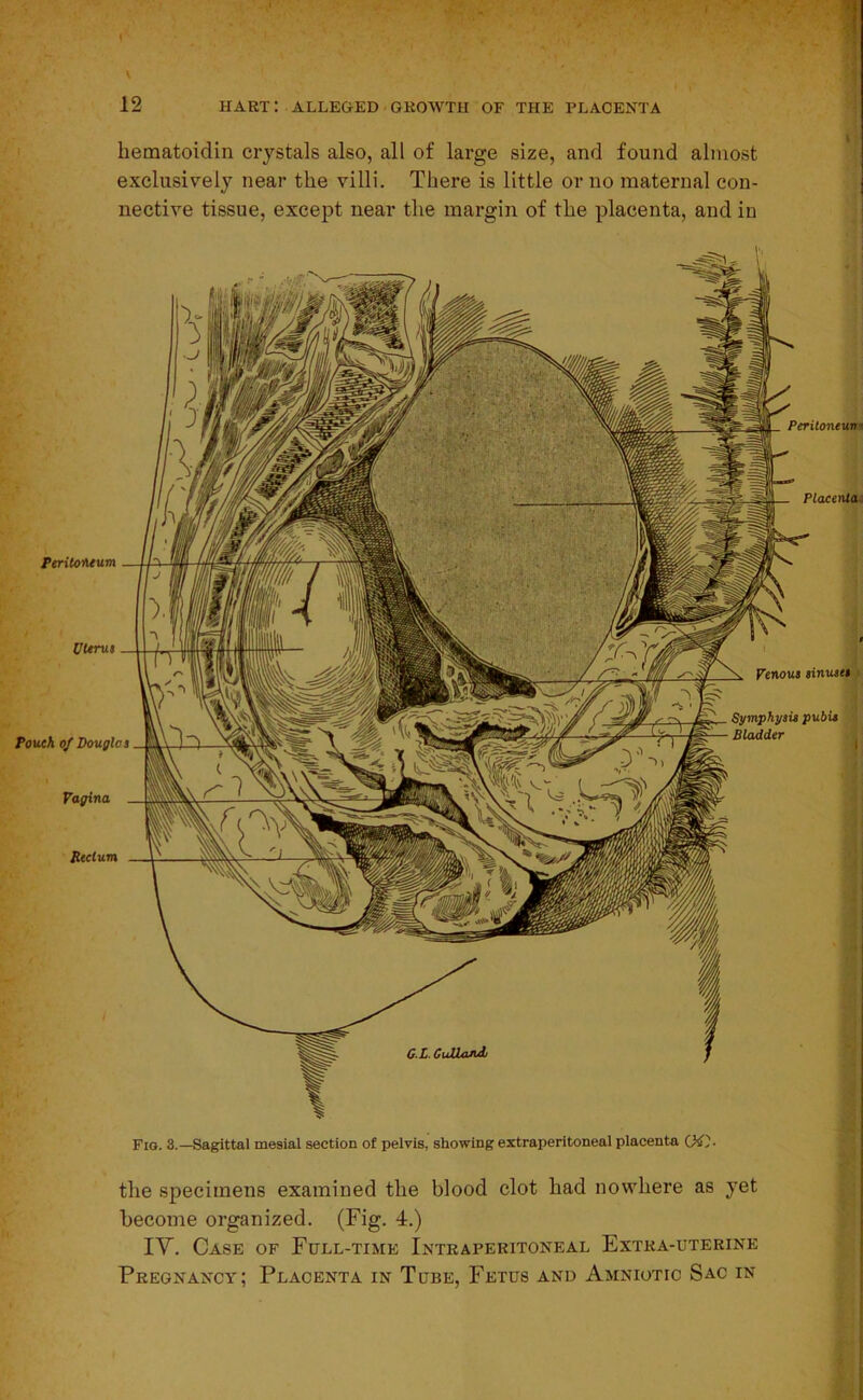 hematoidin crystals also, all of large size, and found almost exclusively near the villi. There is little or no maternal con- nective tissue, except near the margin of the placenta, and in Fig. 3.—Sagittal mesial section of pelvis, showing extraperitoneal placenta (X). the specimens examined the blood clot had nowhere as yet become organized. (Fig. 4.) IY. Case of Full-time Intraperitoneal Extra-uterine Pregnancy; Placenta in Tube, Fetus and Amniotic Sac in Peritoneum Uterus Pouch of Douglas Vagina Reclum Peritoneuw Placenta Venous sinuses Symphysis pubis Bladder