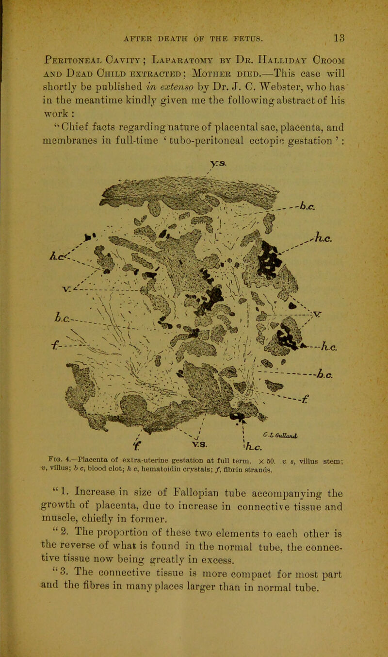 Peritoneal Cavity ; Laparatomy by Dr. Halliday Croom and Dead Child extracted ; Mother died.—This case will shortly be published in extenso by Dr. J. C. Webster, who has in the meantime kindly given me the following abstract of his work : ‘‘Chief facts regarding nature of placental sac, placenta, and membranes in full-time ‘ tubo-peritoneal ectopic gestation ’ : ys. Fig. 4.—Placenta of extra-uterine gestation at full term, x 50. v s, villus stem; v, villus; b c, blood clot; h c, hematoidin crystals; /, fibrin strands. “ 1. Increase in size of Fallopian tube accompanying the growth of placenta, due to increase in connective tissue and muscle, chiefly in former. “ 2. The proportion of these two elements to each other is the reverse of what is found in the normal tube, the connec- tive tissue now being greatly in excess. “3. The connective tissue is more compact for most part and the fibres in many places larger than in normal tube.