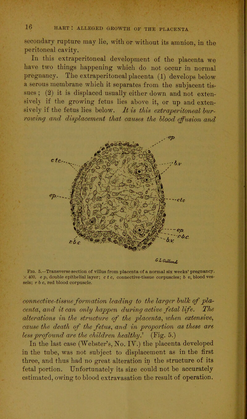 secondary rupture may lie, with or without its amnion, in the peritoneal cavity. In this extraperitoneal development of the placenta we have two things happening which do not occur in normal pregnancy. The extraperitoneal placenta (1) develops below a serous membrane which it separates from the subjacent tis- sues ; (2) it is displaced usually either down and not exten- sively if the growing fetus lies above it, or up and exten- sively if the fetus lies below. It is this extraperitoneal bur- rowing and displacement that causes the blood effusion and .*P GLCulUnj, Fig. 5.—Transverse section of villus from placenta of a normal six weeks’ pregnancy. X 400. e p, double epithelial layer; etc, connective-tissue corpuscles; 6 v, blood ves- sels; r b c, red blood corpuscle. connective-tissue formation leading to the larger bulk of pla- centa, and it can only happen during active fetal life. The alterations in the structure of the placenta, when extensive, cause the death of the fetus, and in proportion as these are less prof ound are the children healthyl (Fig. 5.) In the last case (Webster’s, No. IV.) the placenta developed in the tube, was not subject to displacement as in the first three, and thus had no great alteration in the structure of its fetal portion. Unfortunately its size could not be accurately estimated, owing to blood extravasation the result of operation.