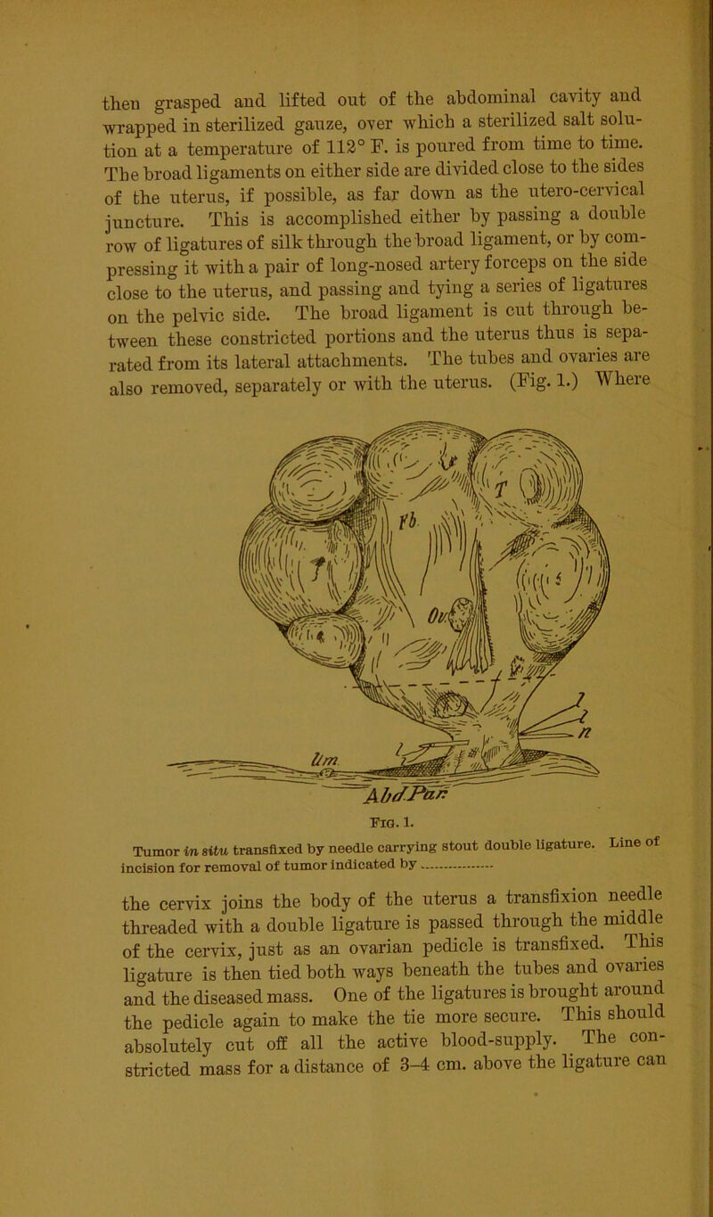 then grasped and lifted out of the abdominal cavity and wrapped in sterilized gauze, over which a sterilized salt solu- tion at a temperature of 112° F. is poured from time to time. The broad ligaments on either side are divided close to the sides of the uterus, if possible, as far down as the utero-cervical juncture. This is accomplished either by passing a double row of ligatures of silk through the broad ligament, 01 by com- pressing it with a pair of long-nosed artery forceps on the side close to the uterus, and passing and tying a series of ligatures on the pelvic side. The broad ligament is cut through be- tween these constricted portions and the uterus thus is sepa- rated from its lateral attachments. The tubes and ovaries are also removed, separately or with the uterus. (Fig. 1.) Where Fig. 1. Tumor in situ transfixed by needle carrying stout double ligature. Line of incision for removal of tumor indicated by the cervix joins the body of the uterus a transfixion needle threaded with a double ligature is passed through the middle of the cervix, just as an ovarian pedicle is transfixed. This ligature is then tied both ways beneath the tubes and ovaries and the diseased mass. One of the ligatures is brought around the pedicle again to make the tie more secure. This should absolutely cut off all the active blood-supply. The con- stricted mass for a distance of 3-4 cm. above the ligature can