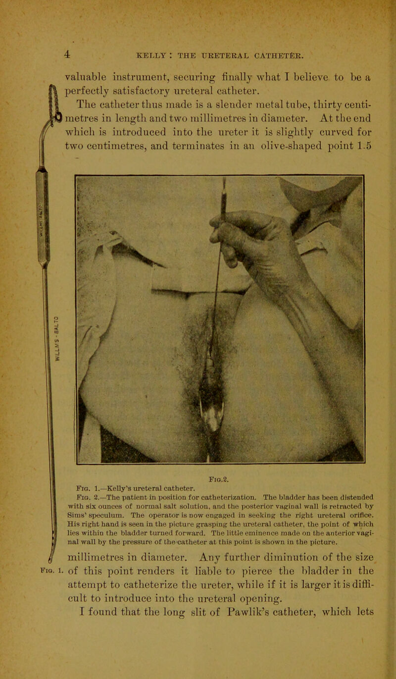 valuable instrument, securing finally what I believe to be a perfectly satisfactory ureteral catheter. The catheter thus made is a slender metal tube, thirty centi- metres in length and two millimetres in diameter. At the end which is introduced into the ureter it is slightly curved for two centimetres, and terminates in an olive-shaped point 1.5 Fig.2. Fig. 1.—Kelly’s ureteral catheter. Fig. 2.—The patient in position for catheterization. The bladder has been distended with six ounces of normal salt solution, and the posterior vaginal wall is retracted by Sims’ speculum. The operator is now engaged in seeking the right ureteral orifice. His right hand is seen in the picture grasping the ureteral catheter, the point of which lies within the bladder turned forward. The little eminence made on the anterior vagi- ; nal wall by the pressure of the catheter at this point is shown in the picture. J I) millimetres in diameter. Any further diminution of the size Fto. i. of this point renders it liable to pierce the bladder in the attempt to catheterize the ureter, while if it is larger it is diffi- cult to introduce into the ureteral opening. I found that the long slit of Pawlik’s catheter, which lets