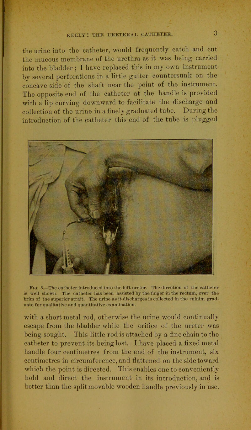 the urine into the catheter, would frequently catch and cut the mucous membrane of the urethra as it was being carried iuto the bladder; I have replaced this in my own instrument by several perforations in a little gutter countersunk on the concave side of the shaft near tlie point of the instrument. The opposite end of the catheter at the handle is provided with a lip curving downward to facilitate the discharge and collection of the urine in a finely graduated tube. During the introduction of the catheter this end of the tube is plugged Fig. 3.—The catheter introduced into the left ureter. The direction of the catheter is well shown. The catheter has been assisted by the finger in the rectum, over the brim of tbe superior strait. The urine as it discharges is collected in the minim grad- uate for qualitative and quantitative examination. with a short metal rod, otherwise the urine would continually escape from the bladder while the orifice of the ureter was being sought. This little rod is attached by a fine chain to the catheter to prevent its being lost. I have placed a fixed metal handle four centimetres from the end of the instrument, six centimetres in circumference, and flattened on the side toward which the point is directed. This enables one to conveniently hold and direct the instrument in its introduction, and is better than the split movable wooden handle previously in use.