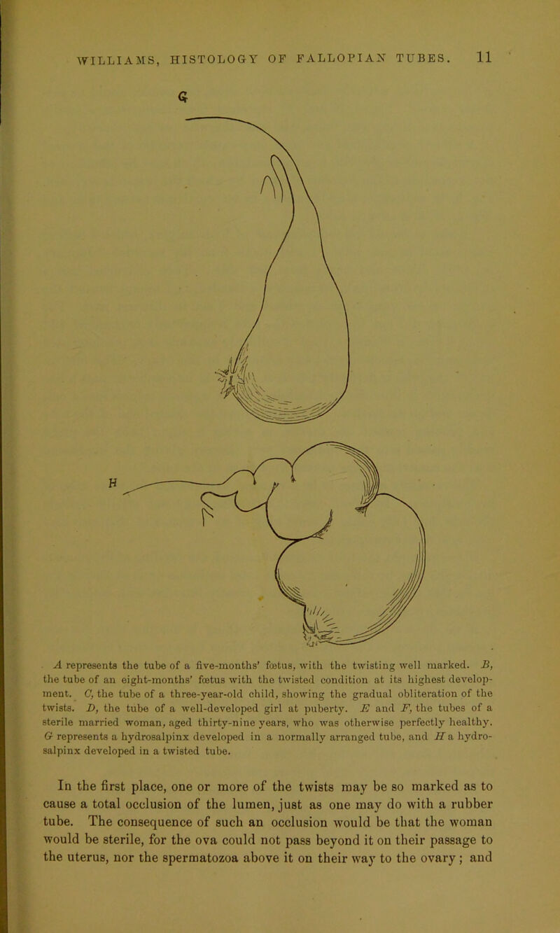 Q A represents the tube of a five-months’ foetus, with the twisting well marked. B, the tube of an eight-months’ foetus with the twisted condition at its highest develop- ment. C, the tube of a three-year-old child, showing the gradual obliteration of the twists. Z>, the tube of a well-developed girl at puberty. E and F, the tubes of a sterile married woman, aged thirty-nine years, who was otherwise perfectly healthy. G represents a hydrosalpinx developed in a normally arranged tube, and Ha hydro- salpinx developed in a twisted tube. In the first place, one or more of the twists may be so marked as to cause a total occlusion of the lumen, just as one may do with a rubber tube. The consequence of such an occlusion would be that the woman would be sterile, for the ova could not pass beyond it on their passage to the uterus, nor the spermatozoa above it on their way to the ovary; and