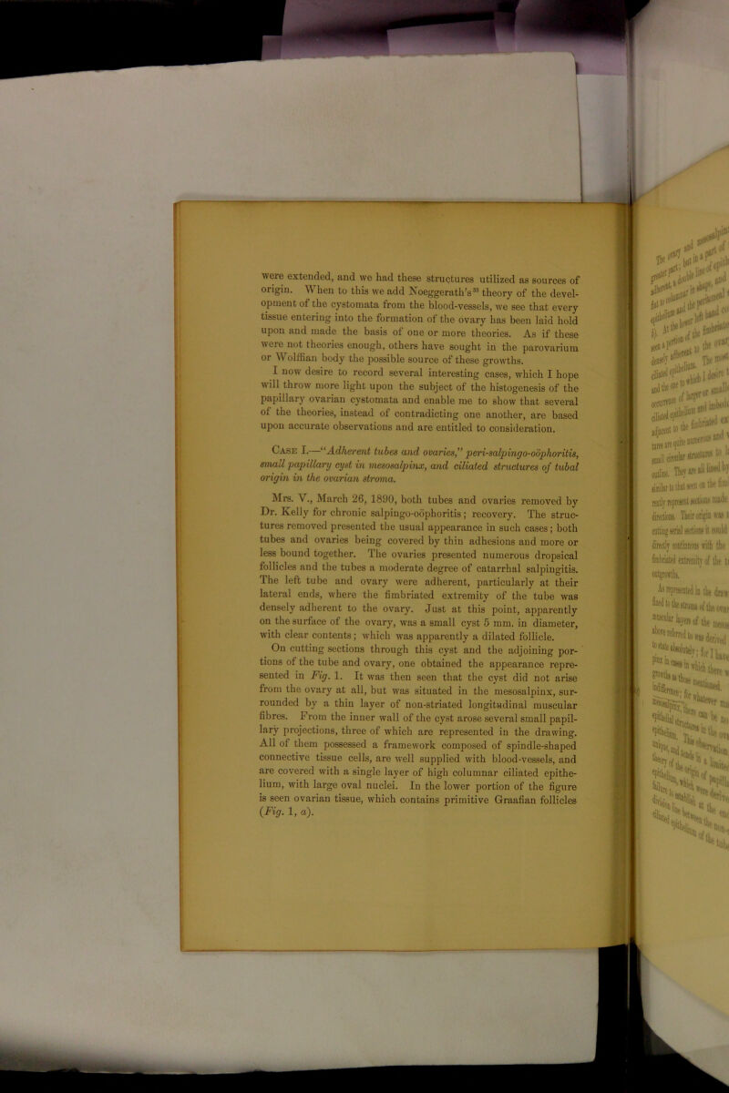 were extended, and we had these structures utilized as sources of origin. When to this we add Noeggerath’s33 theory of the devel- opment of the cystomata from the blood-vessels, we see that every tissue entering into the formation of the ovary has been laid hold upon and made the basis of one or more theories. As if these were not theories enough, others have sought in the parovarium or Wolffian body the possible source of these growths. I now desire to record several interesting cases, which I hope will throw more light upon the subject of the histogenesis of the papillary ovarian cystomata and enable me to show that several of the theories, instead of contradicting one another, are based upon accurate observations and are entitled to consideration. Case I.—“ Adherent tubes and ovaries,” peri-salpingo-obphoritis, small papillary cyst in mesosalpinx, and ciliated structures of tubal origin in the ovarian stroma. Mrs. V., March 26, 1890, both tubes and ovaries removed by Dr. Kelly for chronic salpingo-oophoritis; recovery. The struc- tures removed presented the usual appearance in such cases; both tubes and ovaries being covered by thin adhesions and more or less bound together. The ovaries presented numerous dropsical follicles aud the tubes a moderate degree of catarrhal salpingitis. The left tube and ovary were adherent, particularly at their lateral ends, where the fimbriated extremity of the tube was densely adherent to the ovary. Just at this point, apparently on the surface of the ovary, was a small cyst 5 mm. in diameter, with clear contents; which was apparently a dilated follicle. On cutting sections through this cyst and the adjoining por- tions of the tube and ovary, one obtained the appearance repre- sented in Fig. 1. It was then seen that the cyst did not arise from the ovary at all, but was situated in the mesosalpinx, sur- rounded by a thin layer of non-striated longitudinal muscular fibres. From the inner wall of the cyst arose several small papil- lary projections, three of which are represented in the drawing. All of them possessed a framework composed of spindle-shaped connective tissue cells, are well supplied with blood-vessels, and are covered with a single layer of high columnar ciliated epithe- lium, with large oval nuclei. In the lower portion of the figure is seen ovarian tissue, which contains primitive Graafian follicles {Fig. 1, a).