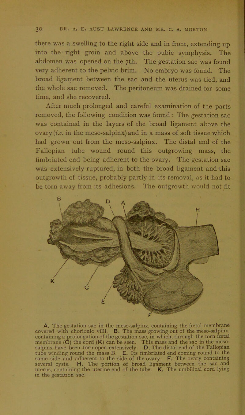 there was a swelling to the right side and in front, extending up into the right groin and above the pubic symphysis. The abdomen was opened on the 7th. The gestation sac was found very adherent to the pelvic brim. No embryo was found. The broad ligament between the sac and the uterus was tied, and the whole sac removed. The peritoneum was drained for some time, and she recovered. After much prolonged and careful examination of the parts removed, the following condition was found: The gestation sac was contained in the layers of the broad ligament above the ovary (i.e. in the meso-salpinx) and in a mass of soft tissue which had grown out from the meso-salpinx. The distal end of the Fallopian tube wound round this outgrowing mass, the fimbriated end being adherent to the ovary. The gestation sac was extensively ruptured, in both the broad ligament and this outgrowth of tissue, probably partly in its removal, as it had to be torn away from its adhesions. The outgrowth would not fit A. The gestation sac in the meso-salpinx, containing the foetal membrane covered with chorionic villi. B. The mass growing out of the meso-salpinx, containing a prolongation of the gestation sac, in which, through the torn foetal membrane (C) the cord (K) can be seen. This mass and the sac in the meso- salpinx have been torn open extensively. D. The distal end of the Fallopian tube winding round the mass B. E. Its fimbriated end coming round to the same side and adherent to the side of the ovary. F. The ovary containing several cysts. H. The portion of broad ligament between the sac and uterus, containing the uterine end of the tube. K. The umbilical cord lying in the gestation sac.