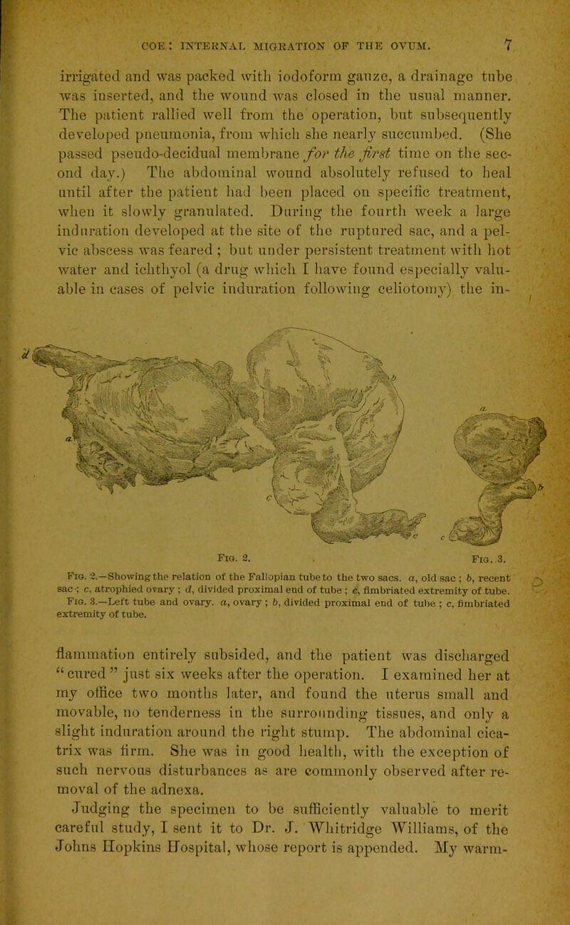 irrigated and was packed with iodoform gauze, a drainage tube was inserted, and the wound was closed in the usual manner. The patient rallied well from the operation, but subsequently developed pneumonia, from which she nearly succumlied. (She passed pseudo-decidual membrane/hr the first time on the sec- ond day.) Tlie abdominal wound absolutely refused to heal until after the patient had been placed on specific treatment, when it slowly granulated. During the fourth week a large induration developed at the site of the ruptured sac, and a pel- vic abscess was feared ; but under persistent treatment with hot water and ichthyol (a drug which I have found especially valu- able in cases of pelvic induration following celiotomy) the in- Fio. 2. Fig. 3. Fig. 2.—Showing the relation of the Fallopian tube to the two sacs, a, old sac ; ft, recent sac-; c, atrophied ovary ; d, divided proximal end of tube ; c, fimbriated extremity of tube. Fig. 3.—Left tube and ovary, a, ovary ; 6, divided proximal end of tube ; c, fimbriated extremity of tube. flammation entirely subsided, and the patient was discharged “ cured ” just six weeks after the operation. I examined her at my office two mouths later, and found the uterus small and movable, no tenderness in the surrounding tissues, and only a slight induration around the right stump. The abdominal cica- trix was firm. She was in good health, with the exception of such nervous disturbances as are commonly observed after re- moval of the adnexa. Judging the specimen to be sufficiently valuable to merit careful study, I sent it to Dr. J. Whitridge Williams, of the Johns Hopkins Hospital, whose report is appended. My warm-