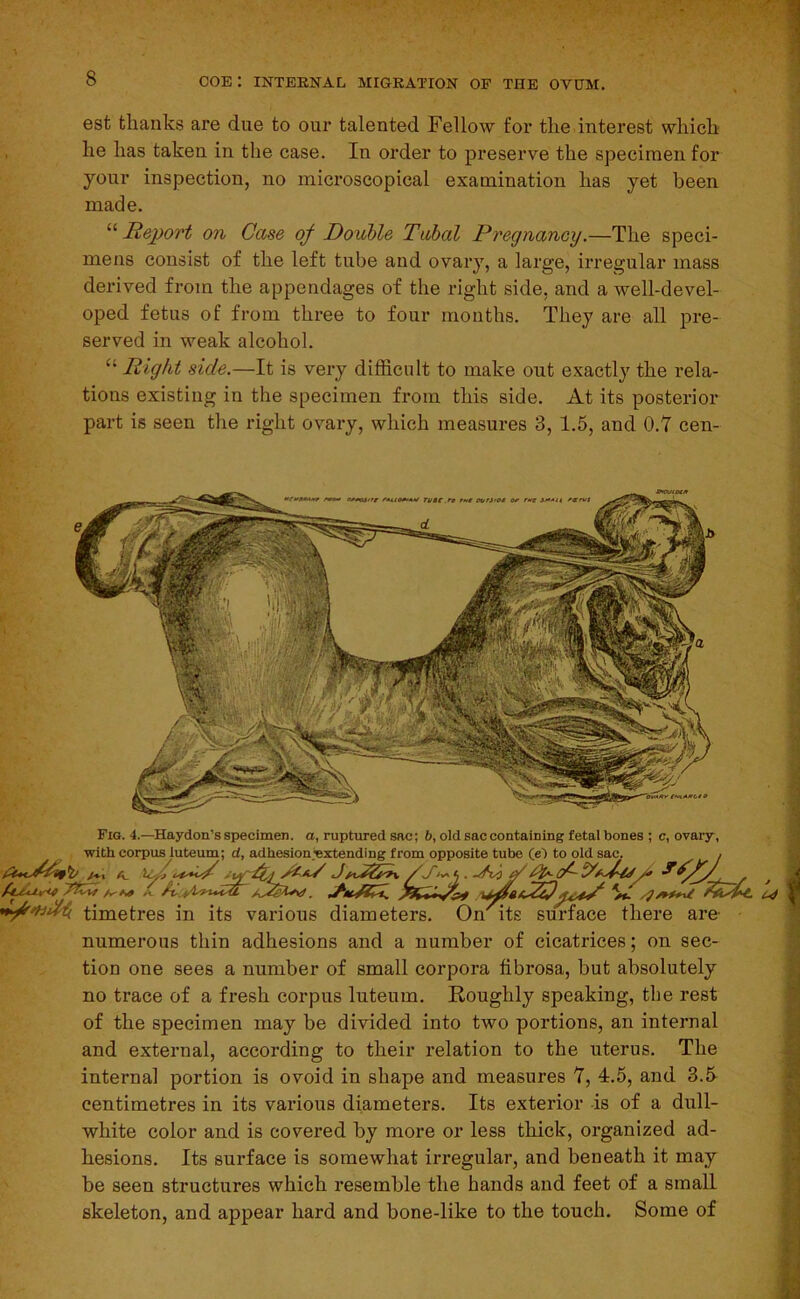 est thanks are due to our talented Fellow for the interest which he has taken in the case. In order to preserve the specimen for your inspection, no microscopical examination has yet been made. “ Report on Case of Double Tabal Pregnancy.—The speci- mens consist of the left tube and ovary, a large, irregular mass derived from the appendages of the right side, and a well-devel- oped fetus of from three to four months. They are all pre- served in weak alcohol. Right side.—It is very difficult to make out exactly the rela- tions existing in the specimen from this side. At its posterior part is seen the right ovary, which measures 3, 1.5, and 0.7 cen- Fig. 4.—Haydon’s specimen, a, ruptured sac; 6, old sac containing fetal bones ; c, ovary, with corpus luteum; d, adhesion^xtending from opposite tube (el to old sac. , A. w/^, , timetres in its various diameters. OnAts surface there are- numerous thin adhesions and a number of cicatrices; on sec- tion one sees a number of small corpora fibrosa, but absolutely no trace of a fresh corpus luteum. Roughly speaking, the rest of the specimen may be divided into two portions, an internal and external, according to their relation to the uterus. The internal portion is ovoid in shape and measures 7, 4.5, and 3.h centimetres in its various diameters. Its exterior is of a dull- white color and is covered by more or less thick, organized ad- hesions. Its surface is somewhat irregular, and beneath it may be seen structures which resemble the hands and feet of a small skeleton, and appear hard and bone-like to the touch. Some of