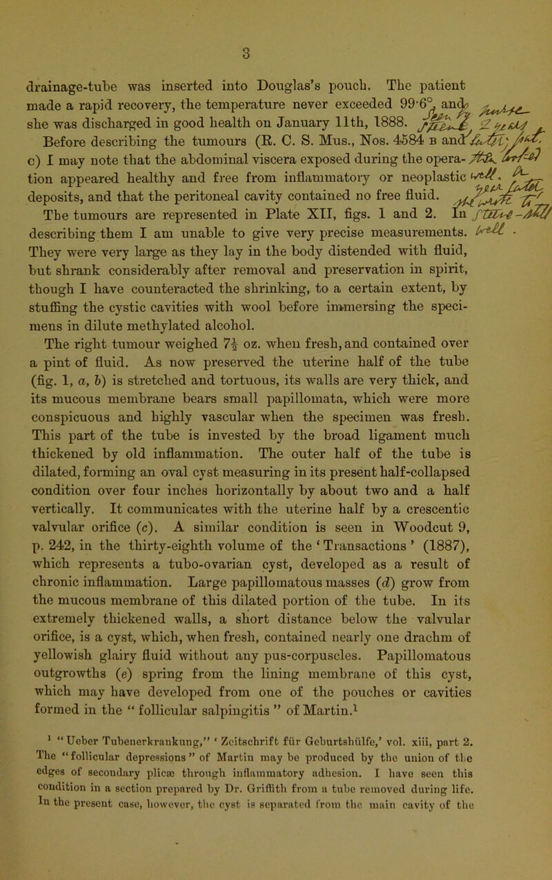 drainage-tube was inserted into Douglas’s pouch. The patient made a rapid recovery, the temperature never exceeded 99-6° ancb l health on January 11th, 1888. she was discharged in good Before describing the tumours (R. C. S. Mus., Nos. 4584 b and c) I may note that the abdominal viscera exposed during the opera- £*/=$ tion appeared healthy and free from inflammatory or neoplastic - fS-r deposits, and that the peritoneal cavity contaiued no free fluid, Tbe tumours are represented in Plate XII, figs. 1 and 2. In describing them I am unable to give very precise measurements. - They were very large as they lay in the body distended with fluid, but shrank considerably after removal and preservation in spirit, though I have counteracted the shrinking, to a certain extent, by stuffing the cystic cavities with wool before immersing the speci- mens in dilute methylated alcohol. The right tumour weighed 7i oz. when fresh, and contained over a pint of fluid. As now preserved the uterine half of the tube (fig. 1, a, b) is stretched and tortuous, its walls are very thick, and its mucous membrane bears small papillomata, which were more conspicuous and highly vascular when the specimen was fresh. This part of the tube is invested by the broad ligament much thickened by old inflammation. The outer half of the tube is dilated, forming an oval cyst measuring in its present half-collapsed condition over four inches horizontally by about two and a half vertically. It communicates with the uterine half by a crescentic valvular orifice (c). A similar condition is seen in Woodcut 9, p. 242, in the thirty-eighth volume of the ‘ Transactions ’ (1887), which represents a tubo-ovarian cyst, developed as a result of chronic inflammation. Large papillomatous masses (d) grow from the mucous membrane of this dilated portion of the tube. In its extremely thickened walls, a short distance below the valvular orifice, is a cyst, which, when fresh, contained nearly one drachm of yellowish glairy fluid without any pus-corpuscles. Papillomatous outgrowths (e) spring from the lining membrane of this cyst, which may have developed from one of the pouches or cavities formed in the “ follicular salpingitis ” of Martin.1 1 “Ueber Tubenerkraukuug,” * Zcitschrift fur Geburtsliiilfe,’ vol. xiii, part 2. Tbe “ follicular depressions ” of Martin may be produced by tbe union of tbe edges of secondary plicae through inflammatory adhesion. I have seen this condition in a section prepared by Dr. Griffith from a tube removed during life. In the present case, however, the cyst is separated from the main cavity of the