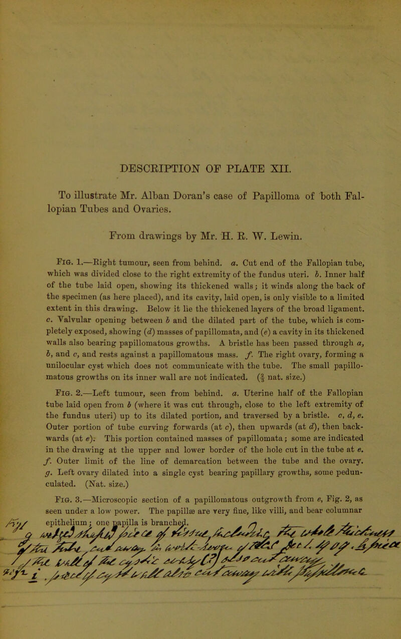 DESCRIPTION OF PLATE XII. To illustrate Mr. Alban Doran’s case of Papilloma of both Fal- lopian Tubes and Ovaries. From drawings by Mr. H. R. W. Lewin. Fig. 1.—Right tumour, seen from behind, a. Cut end of the Fallopian tube, which was divided close to the right extremity of the fundus uteri, b. Inner half of the tube laid open, showing its thickened walls; it winds along the back of the specimen (as here placed), and its cavity, laid open, is only visible to a limited extent in this drawing. Below it lie the thickened layers of the broad ligament. c. Valvular opening between b and the dilated part of the tube, which is com- pletely exposed, showing (d) masses of papillomata, and (e) a cavity in its thickened walls also bearing papillomatous growths. A bristle has been passed through a, b, and c, and rests against a papillomatous mass. f. The right ovary, forming a unilocular cyst which does not communicate with the tube. The small papillo- matous growths on its inner wall are not indicated, (f nat. size.) Fig. 2.—Left tumour, seen from behind, a. Uterine half of the Fallopian tube laid open from b (where it was cut through, close to the left extremity of the fundus uteri) up to its dilated portion, and traversed by a bristle, c, d, e. Outer portion of tube curving forwards (at c), then upwards (at d), then back- wards (at e). This portion contained masses of papillomata; some are indicated in the drawing at the upper and lower border of the hole cut in the tube at e. f. Outer limit of the line of demarcation between the tube and the ovary. g. Left ovary dilated into a single cyst bearing papillary growths, some pedun- culated. (Nat. size.) Fig. 3.—Microscopic section of a papillomatous outgrowth from e, Fig. 2, as seen under a low power. The papillae are very fine, like villi, and bear columnar