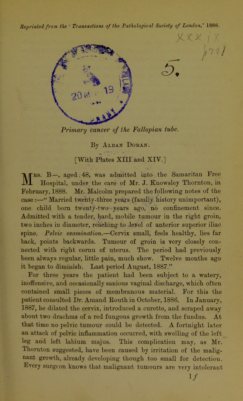 Reprinted from the ' Transactions of the Pathological Society of London,' 1888. Mbs. B—, aged.48j was admitted into the Samaritan Free Hospital, under the care of Mr. J. Knowsley Thornton, in February, 1888. Mr. Malcolm prepared the following notes of the case :—“ Married twenty-three ye^s (family history unimportant), one child born twenty-two-years ago,' no confinement since. Admitted with a tender, hard, mobile tumour in the right groin, two inches in diameter, reaching to .leyel of anterior superior iliac spine. Pelvic examination.—Cervix small, feels healthy, lies far back, points backwards. Tumour of groin is very closely con- nected with right cornu of uterus. The period had previously been always regular, little pain, much show. Twelve months ago it began to diminish. Last period August, 1887.” For three years the patient had been subject to a watery, inoffensive, and occasionally sanious vaginal discharge, which often contained small pieces of membranous material. For this the patient consulted Dr. Amand Eouth in October, 1886. In January, 1887, he dilated the cervix, introduced a curette, and scraped away about two drachms of a red fungous growth from the fundus. At that time no pelvic tumour could be detected. A fortnight later an attack of pelvic inflammation occurred, with swelling of the left leg and left labium majus. This complication may, as Mr. Thornton suggested, have been caused by irritation of the malig- nant growth, already developing though too small for detection. Every surgeon knows that malignant tumours are very intolerant Primary cancer of the Fallopian tube. By Alban Doran. [With Plates XIII arid XIV.] 1/