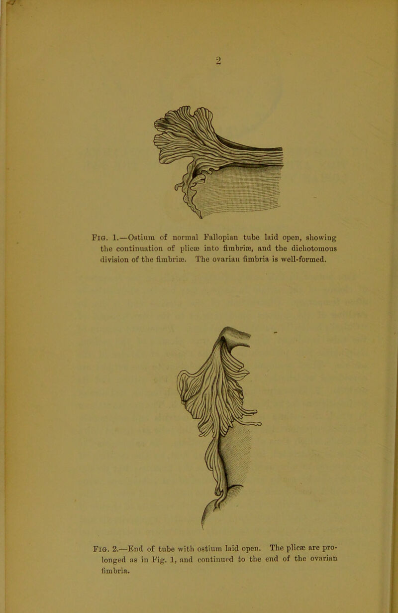 Fig. 1.—Ostium of normal Fallopian tube laid open, showing the continuation of plica into fimbria, and the dichotomous division of the fimbria. The ovarian fimbria is well-formed. Fig. 2.—End of tube with ostium laid open. The plica are pro- longed as in Fig. 1, and continued to the end of the ovarian fimbria.