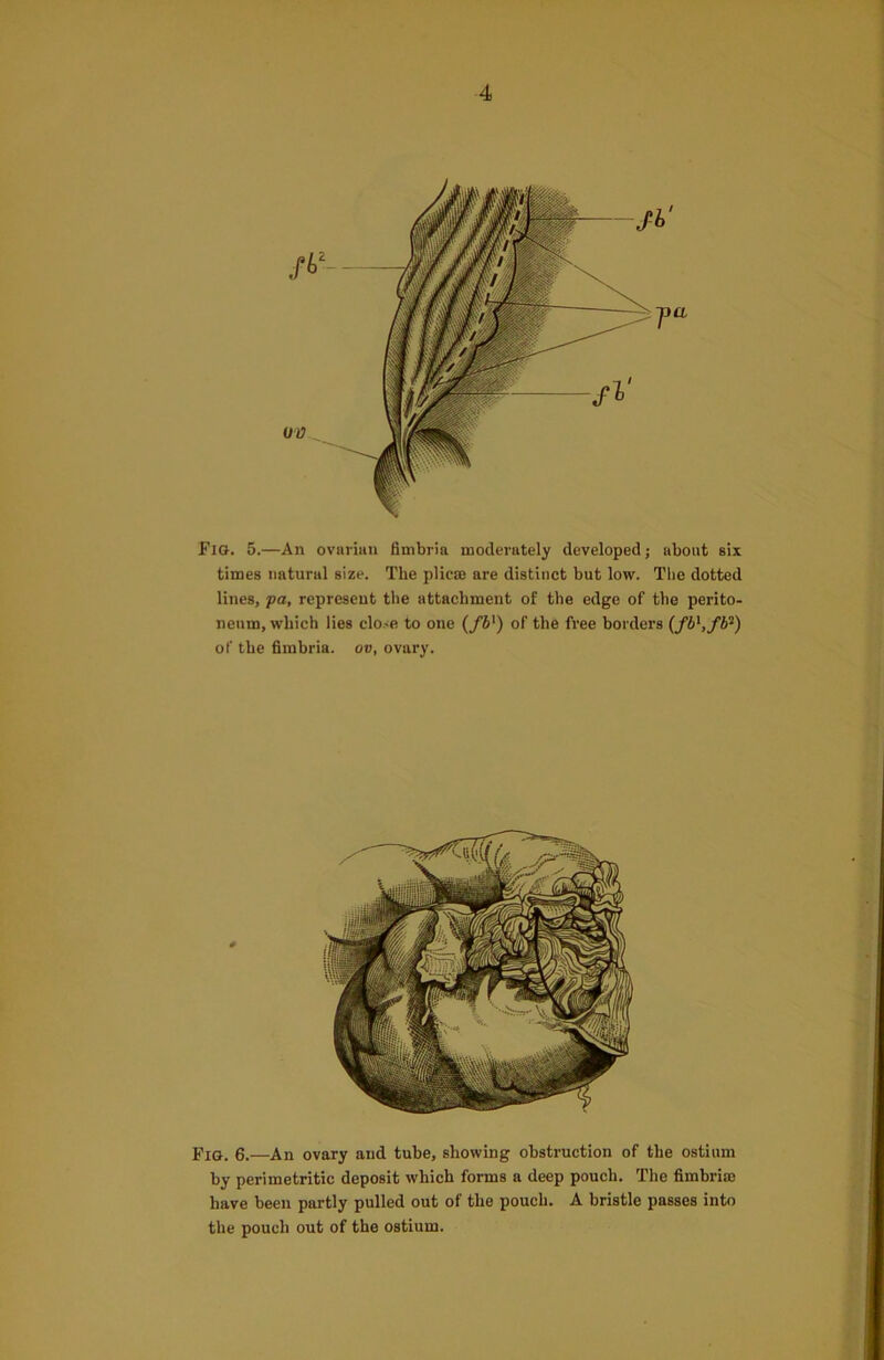 Fig. 5.—An ovarian fimbria moderately developed; about six times natural size. The plicae are distinct but low. The dotted lines, fa, represent the attachment of the edge of the perito- neum, which lies close to one (fb]) of the free borders (/i',/62) of the fimbria, ov, ovary. Fig. 6.—An ovary and tube, showing obstruction of the ostium by perimetritic deposit which forms a deep pouch. The fimbria) have been partly pulled out of the pouch. A bristle passes into the pouch out of the ostium.