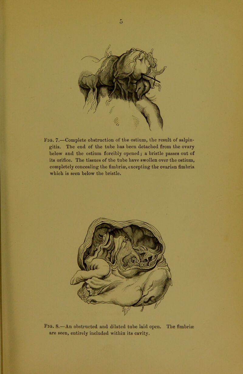 Fig. 7.—Complete obstruction of the ostium, the result of salpin- gitis. The end of the tube has been detached from the ovary below and the ostium forcibly opened; a bristle passes out of its orifice. The tissues of the tube have swollen over the ostium, completely concealing the fimbriae, excepting the ovarian fimbria which is seen below the bristle. Fig. 8.—An obstructed and dilated tube laid open. The fimbria) are seen, entirely included within its cavity.