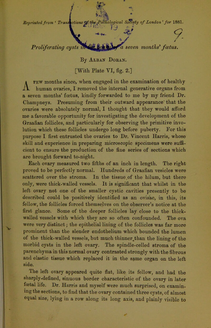 < _ Reprinted from ‘ Transitions qf. the ^Pathological Society of London’ for 1881. 1 * - • if./', ;• | 4 * » 1 <?. Proliferating cysts *a seven months’ foetus. By Alban Doean. [With Plate YI, fig. 2.] A few months since, when engaged in the examination of healthy- human ovaries, I removed the internal generative organs from a seven months’ foetus, kindly forwarded to me by my friend Dr. Champneys. Presuming from their outward appearance' that the ovaries were absolutely normal, I thought that they would afford me a favorable opportunity for investigating the development of the Graafian follicles, and particularly for observing the primitive invo- lution which these follicles undergo long before puberty. Por this purpose I first entrusted the ovaries to Dr. Vincent Harris, whose skill and experience in preparing microscopic specimens were suffi- cient to ensure the production of the fine series of sections which are brought forward to-night. Each ovary measured two fifths of an inch in length. The right proved to be perfectly normal. Hundreds of Graafian vesicles were scattered over the stroma. In the tissue.of the hilum, but there only, were thick-walled vessels. It is significant that whilst in the left ovary not one of the smaller cystic cavities presently to be described could be positively identified as an ovisac, in this, its fellow, the follicles forced themselves on the observer’s notice at the first glance. Some of the deeper follicles lay close to the thick- walled vessels with which they are so often confounded. The ova were very distinct; the epithelial lining of the follicles was far more prominent than the slender endothelium which bounded the lumen of the thick-walled vessels, but much thinner^than the lining of the morbid cysts in the left ovary. The spindle-celled stroma of the parenchyma in this normal ovary contrasted strongly with the fibrous and elastic tissue which replaced it in the same organ on the left side. The left ovary appeared quite flat, like its fellow, and had the sharply-defined, sinuous border characteristic of the ovary in later fcetal life. Dr. Harris and myself were much surprised, on examin- ing the sections, to find that the ovary contained three cysts, of almost equal size, lying in a row along its long axis, and plainly visible to