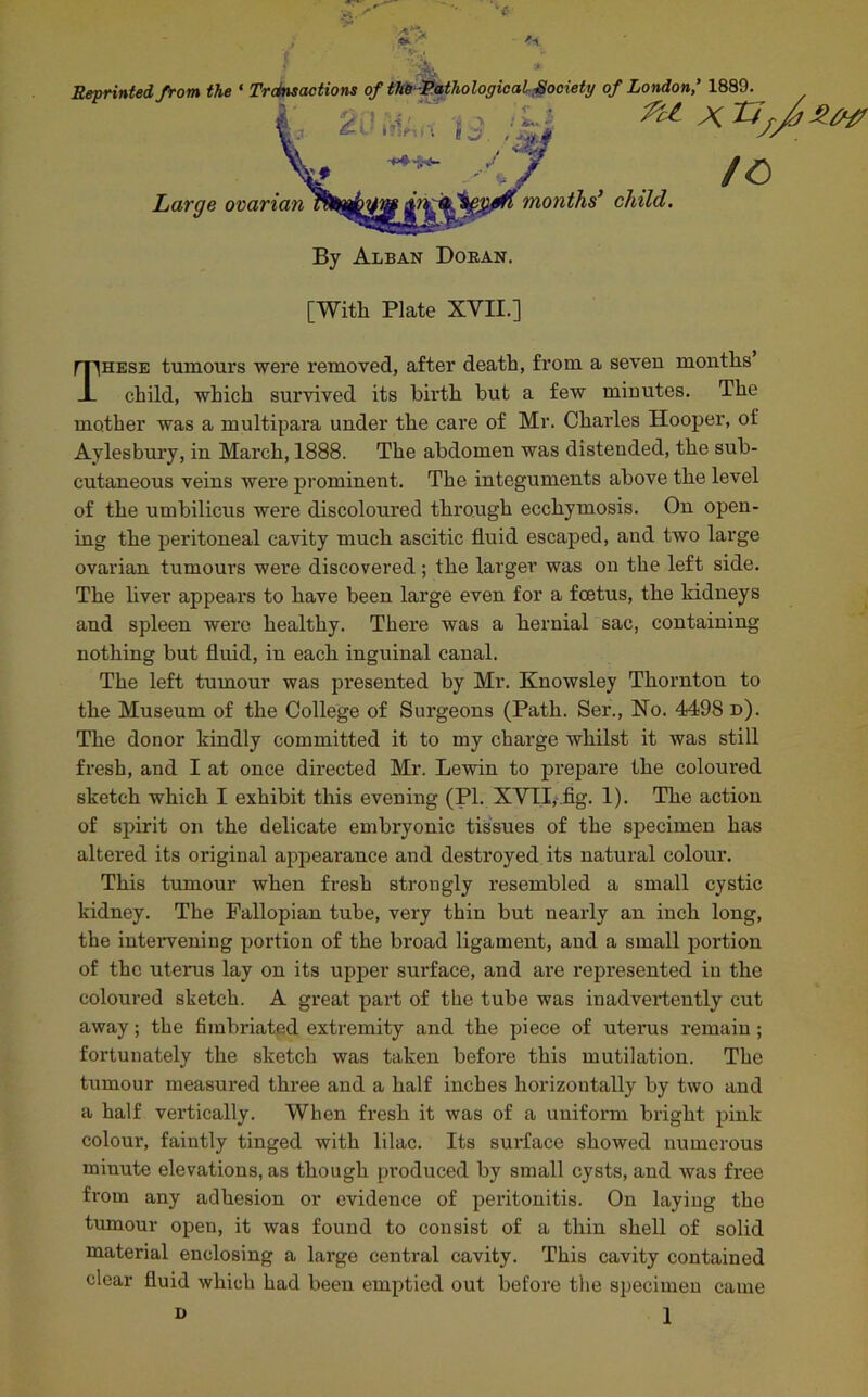 Reprinted from the ' Trctnsactions of tW-RathologicalSociety of London,’ 1889. Large ovarian months' child. By Alban Doran. [With Plate XVII.] These tumours were removed, after death, from a seven months child, which survived its birth but a few minutes. The mother was a multipara under the care of Mr. Charles Hooper, of Aylesbury, in March, 1888. The abdomen was distended, the sub- cutaneous veins were prominent. The integuments above the level of the umbilicus were discoloured through ecchymosis. On open- ing the peritoneal cavity much ascitic fluid escaped, and two large ovarian tumours wei’e discovered; the larger was on the left side. The liver appears to have been large even for a foetus, the kidneys and spleen were healthy. There was a hernial sac, containing nothing but fluid, in each inguinal canal. The left tumour was presented by Mr. Knowsley Thornton to the Museum of the College of Surgeons (Path. Ser., No. 4498 d). The donor kindly committed it to my charge whilst it was still fresh, and I at once directed Mr. Lewin to prepare the coloured sketch which I exhibit this evening (PI. XVII,.fig. 1). The action of spirit on the delicate embryonic tissues of the specimen has altered its original appearance and destroyed its natural colour. This tumour when fresh strongly resembled a small cystic kidney. The Fallopian tube, very thin but nearly an inch long, the intervening portion of the broad ligament, and a small portion of the uterus lay on its upper surface, and are represented in the coloured sketch. A great part of the tube was inadvertently cut away; the fimbriated extremity and the piece of uterus remain; fortunately the sketch was taken before this mutilation. The tumour measured thi’ee and a half inches horizontally by two and a half vertically. When fresh it was of a uniform bright pink colour, faintly tinged with lilac. Its surface showed numerous minute elevations, as though pi’oduced by small cysts, and was free from any adhesion or evidence of peritonitis. On laying the tumour open, it was found to consist of a thin shell of solid material enclosing a large central cavity. This cavity contained clear fluid which had been emptied out before the specimen came