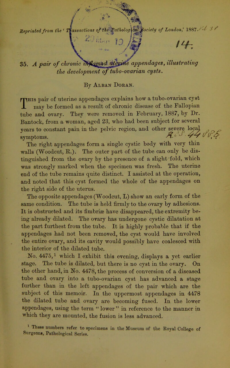 35. A pair of chronic Ifyfam&d tU$%ine appendages, illustrating the development of tubo-ovarian cysts. Reprinted from the ‘ By Alban Doean. This pair of uterine appendages explains how a tubo-ovarian cyst may be formed as a result of chronic disease of the Fallopian tube and ovary. They were removed in February, 1887, by Dr. Bantock, from a woman, aged 23, who bad been subject for several years to constant pain in the pelvic region, and other severe local . _ symptoms. _ f’J ■ The right appendages form a single cystic body with very thin walls (Woodcut, B,.). The outer part of the tube can only be dis- tinguished from the ovary by the presence of a slight fold, which was strongly marked when the specimen was fresh. The uterine end of the tube remains quite distinct. I assisted at the operation, and noted that this cyst formed the whole of the appendages on the right side of the uterus. The opposite appendages (Woodcut, L) show an early form of the same condition. The tube is held firmly to the ovary by adhesions. It is obstructed and its fimbriae have disappeared, the extremity be- ing already dilated. The ovary has undergone cystic dilatation at the part furthest from the tube. It is highly probable that if the appendages had not been removed, the cyst would have involved the entire ovary, and its cavity would possibly have coalesced with the interior of the dilated tube. No. 4475,1 which I exhibit this evening, displays a yet earlier stage. The tube is dilated, but there is no cyst in the ovary. On the other hand, in No. 4478, the process of conversion of a diseased tube and ovary into a tubo-ovarian cyst has advanced a stage further than in the left appendages of the pair which are the subject of this memoir. In the uppermost appendages in 4478 the dilated tube and ovary are becoming fused. In the lower appendages, using the term “ lower” in reference to the manner in which they are mounted, the fusion is less advanced. 1 These numbers refer to specimens in the Museum of the Royal College of Surgeons, Pathological Series.